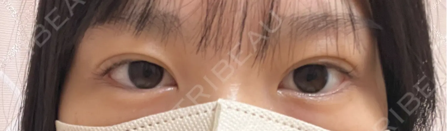 施術後の写真