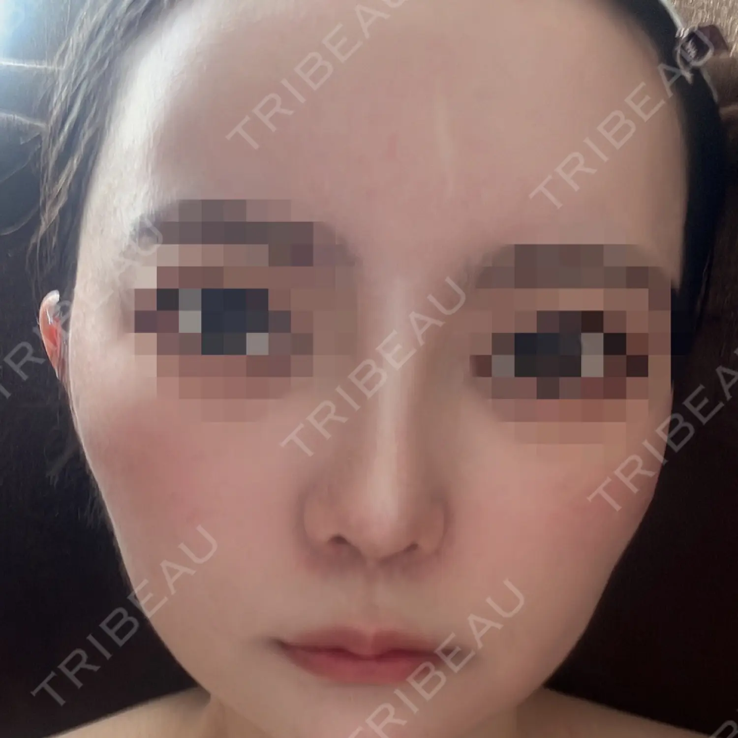 施術後の写真