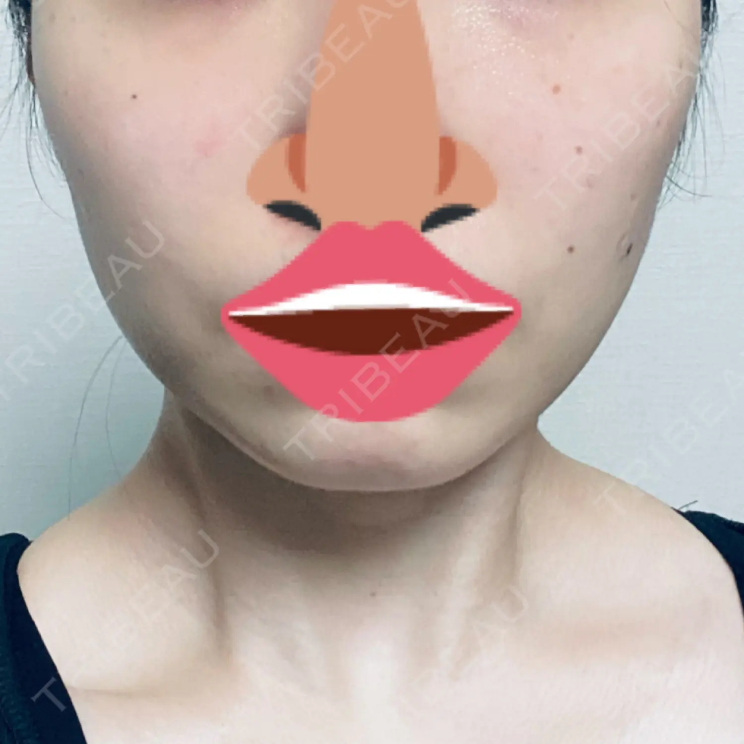 施術後の写真