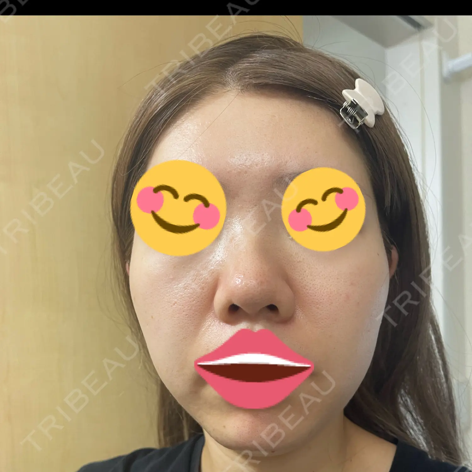 施術後の写真