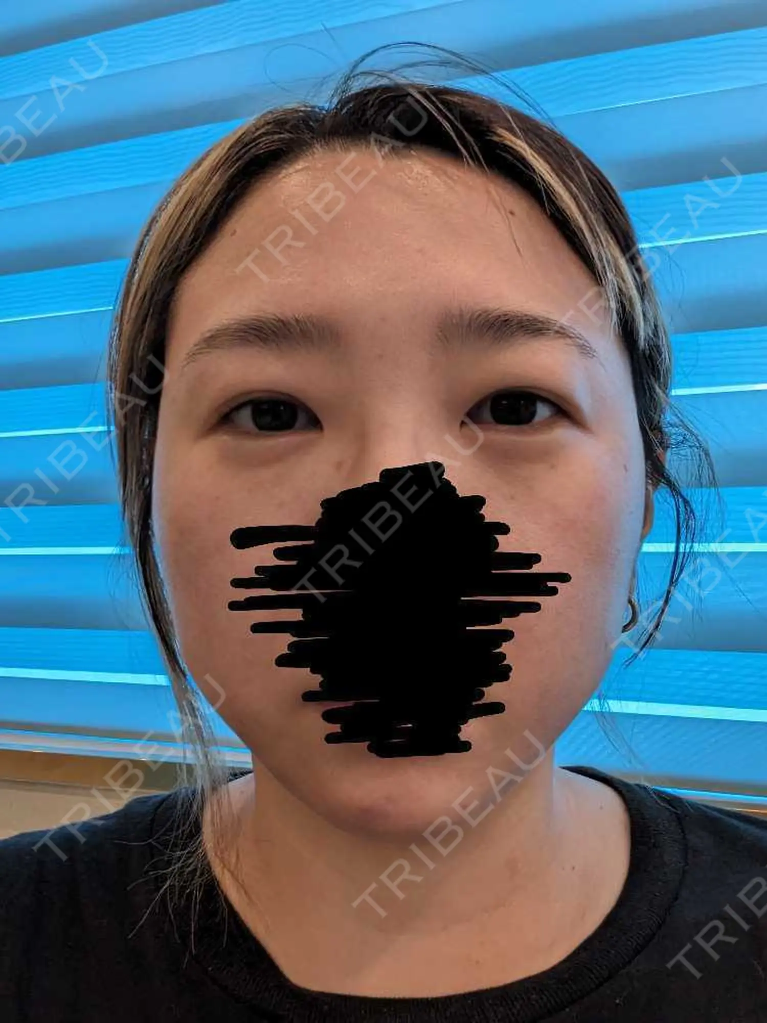 施術後の写真