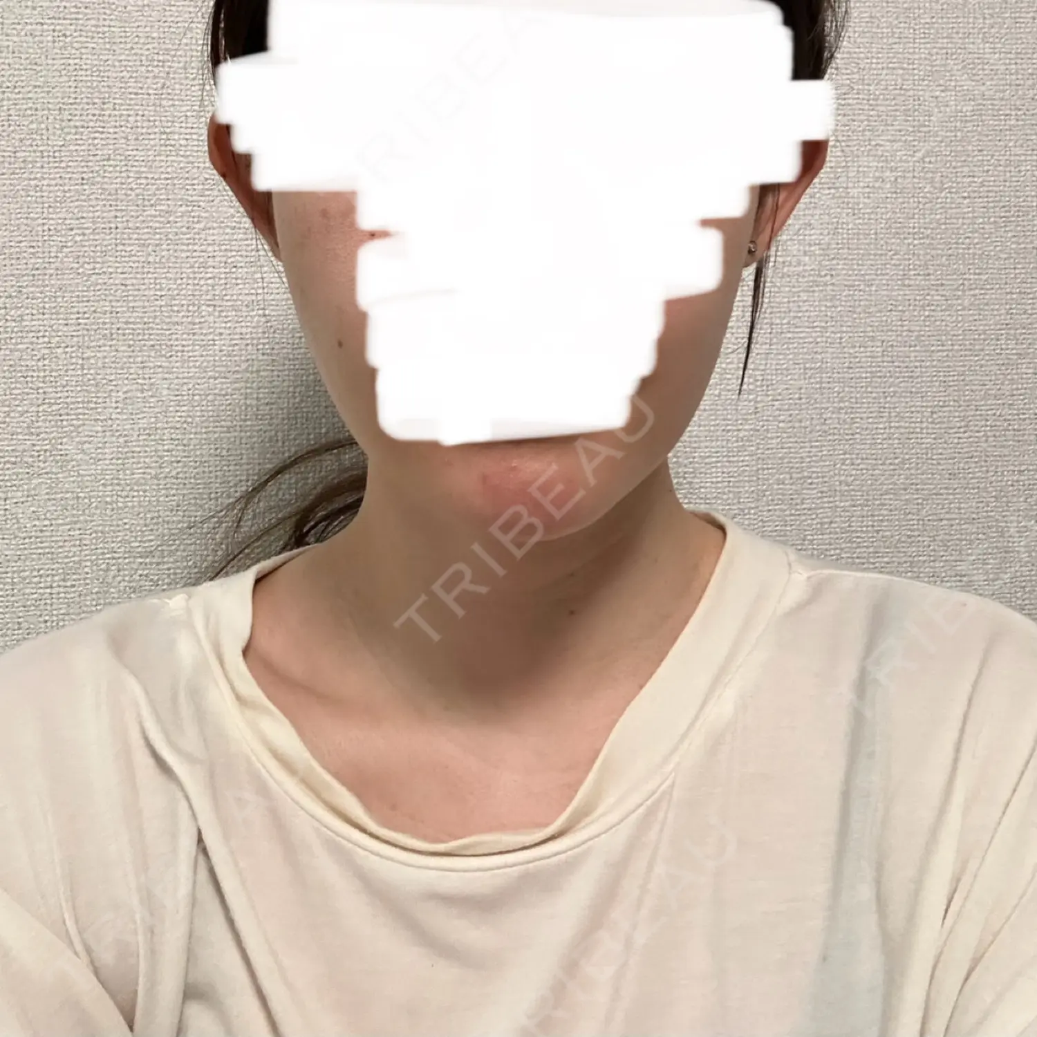 施術後の写真