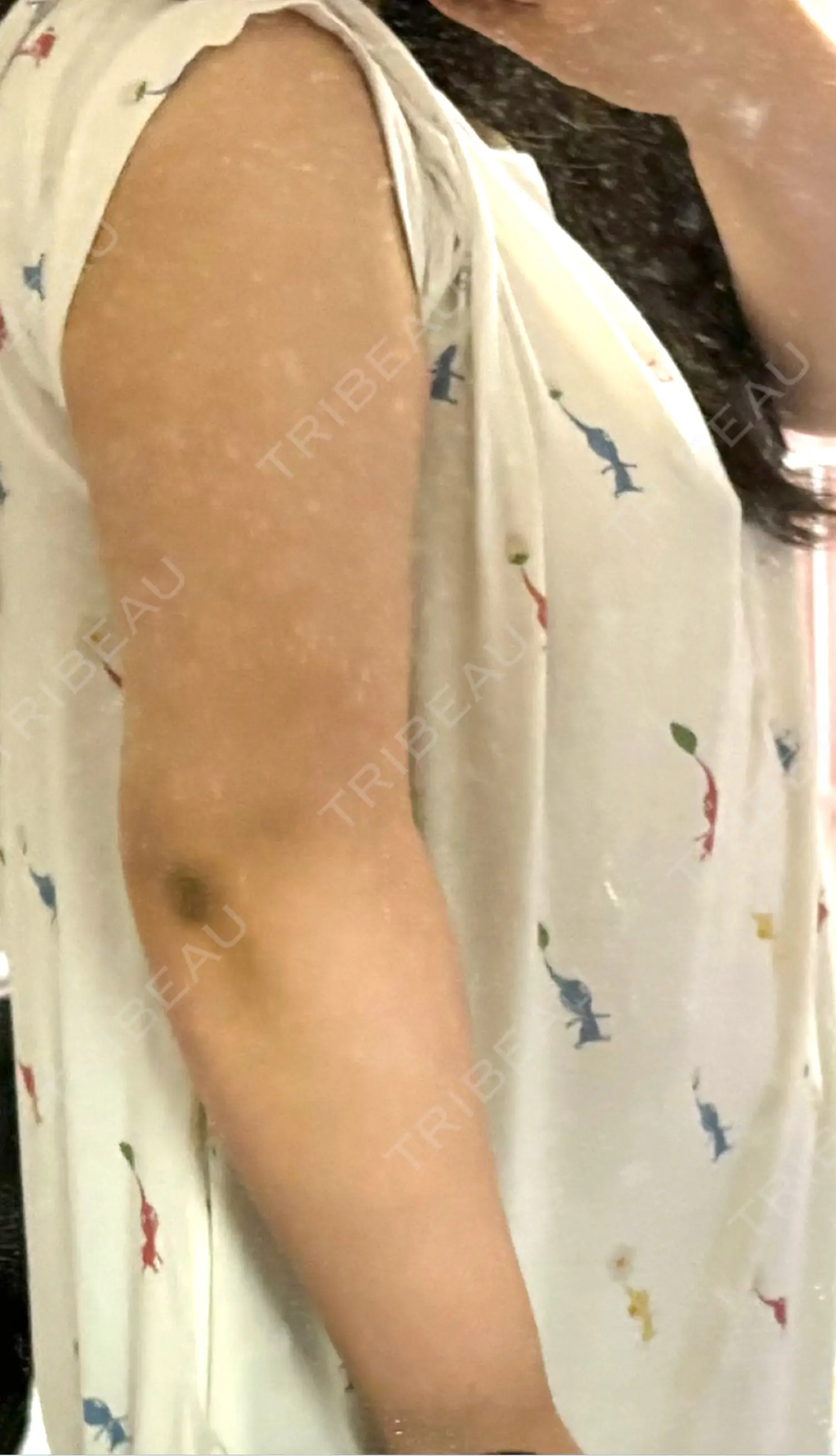 施術後の写真