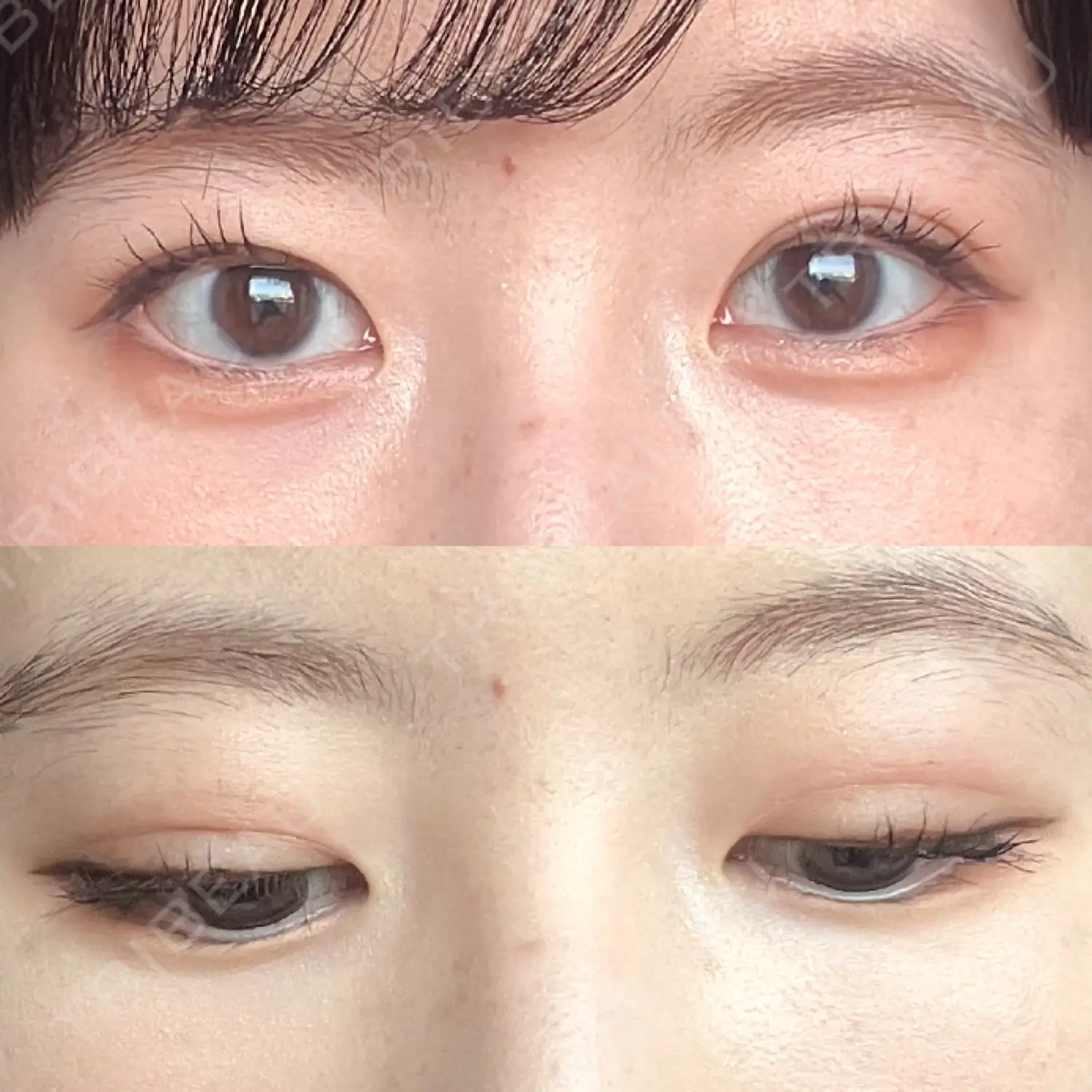 施術後の写真