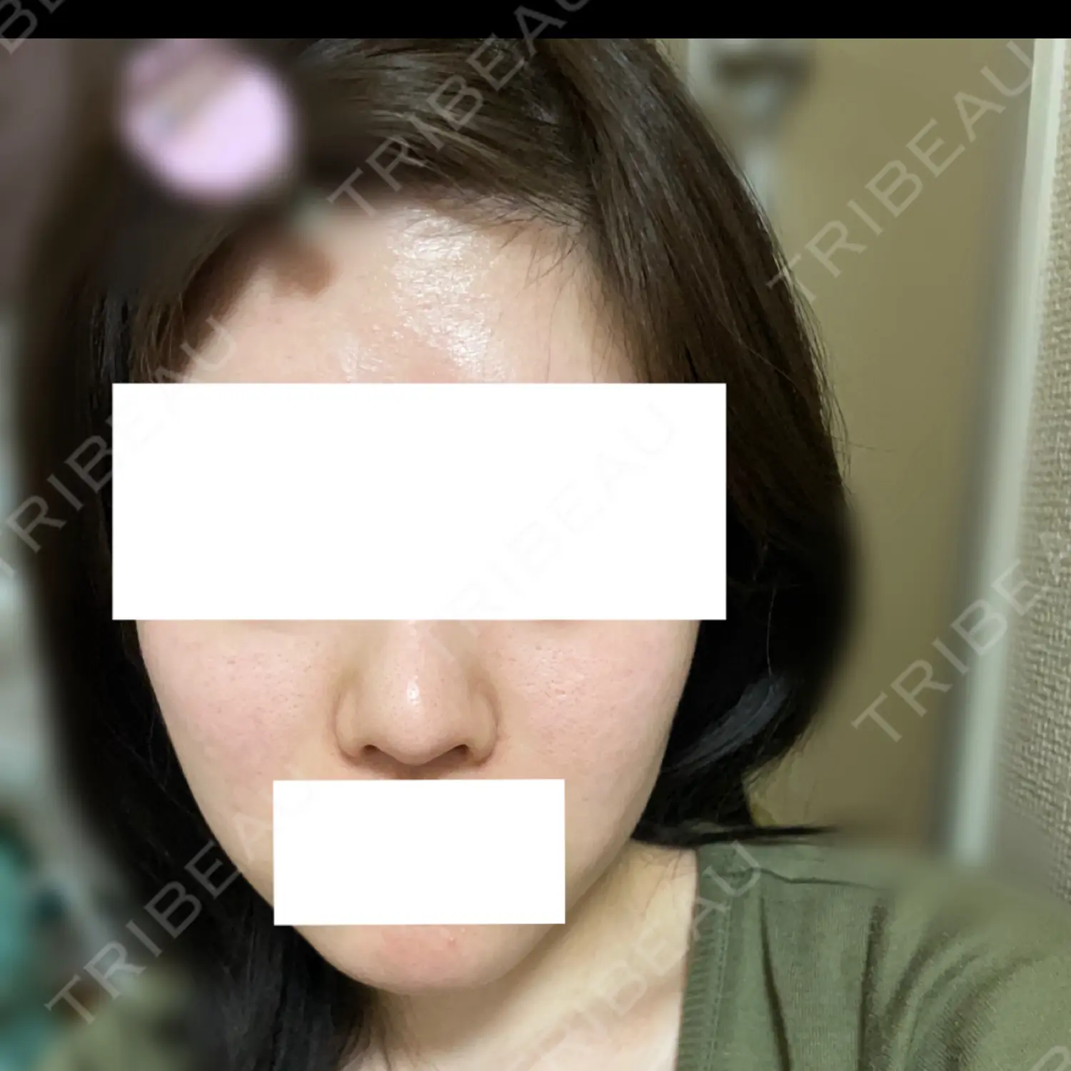 施術後の写真