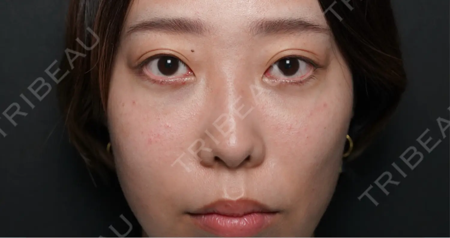 施術後の写真