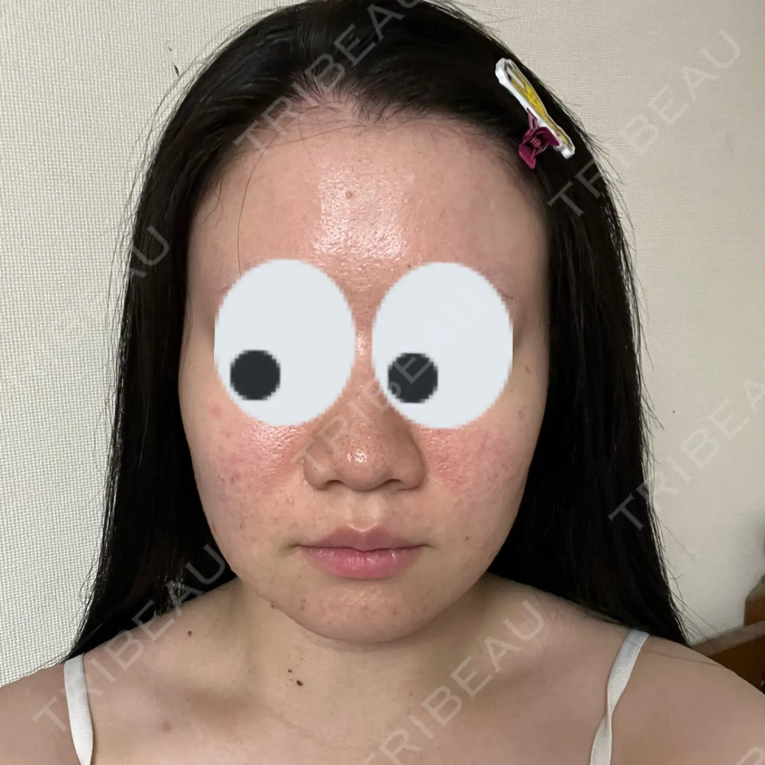 施術後の写真
