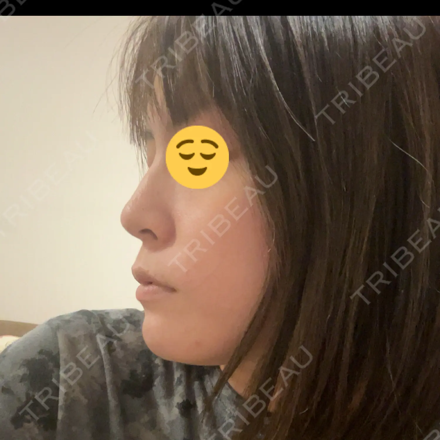 施術後の写真