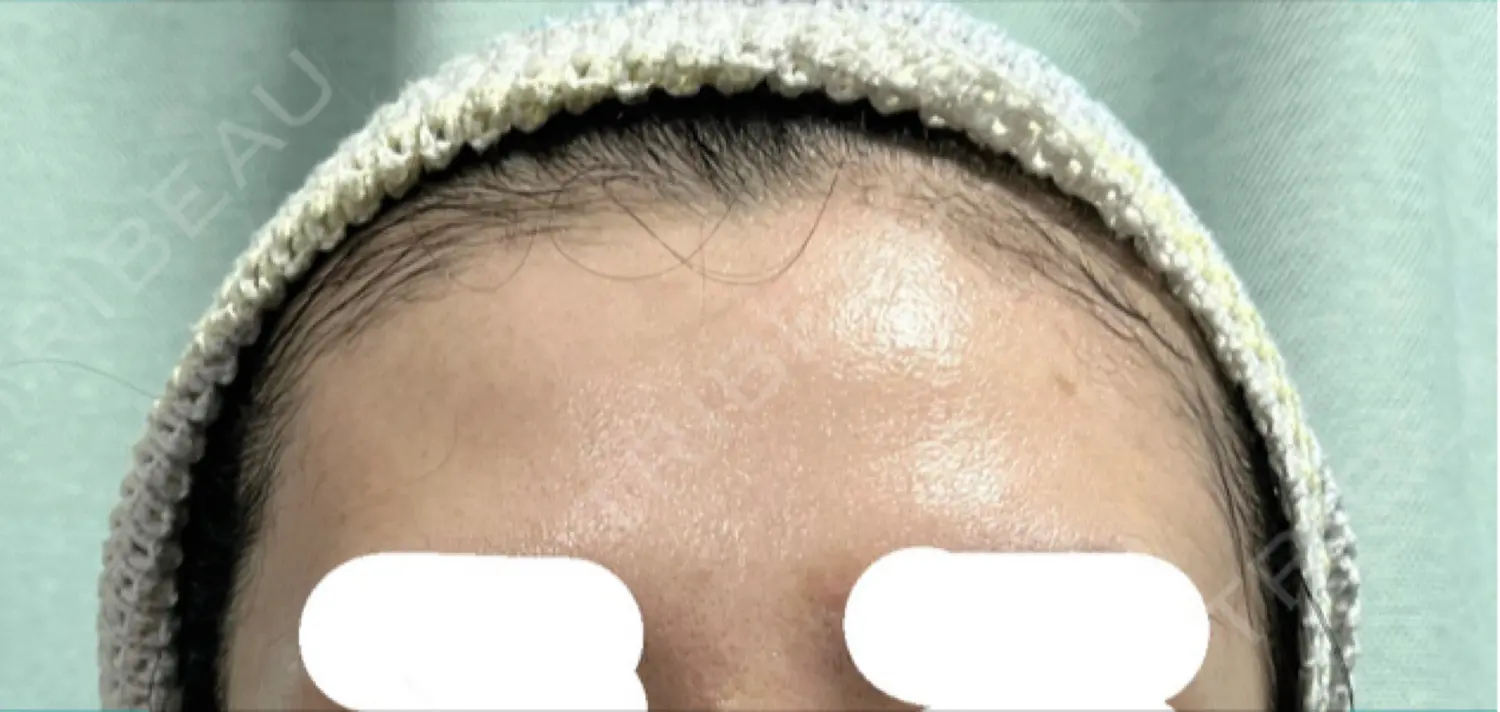 施術後の写真