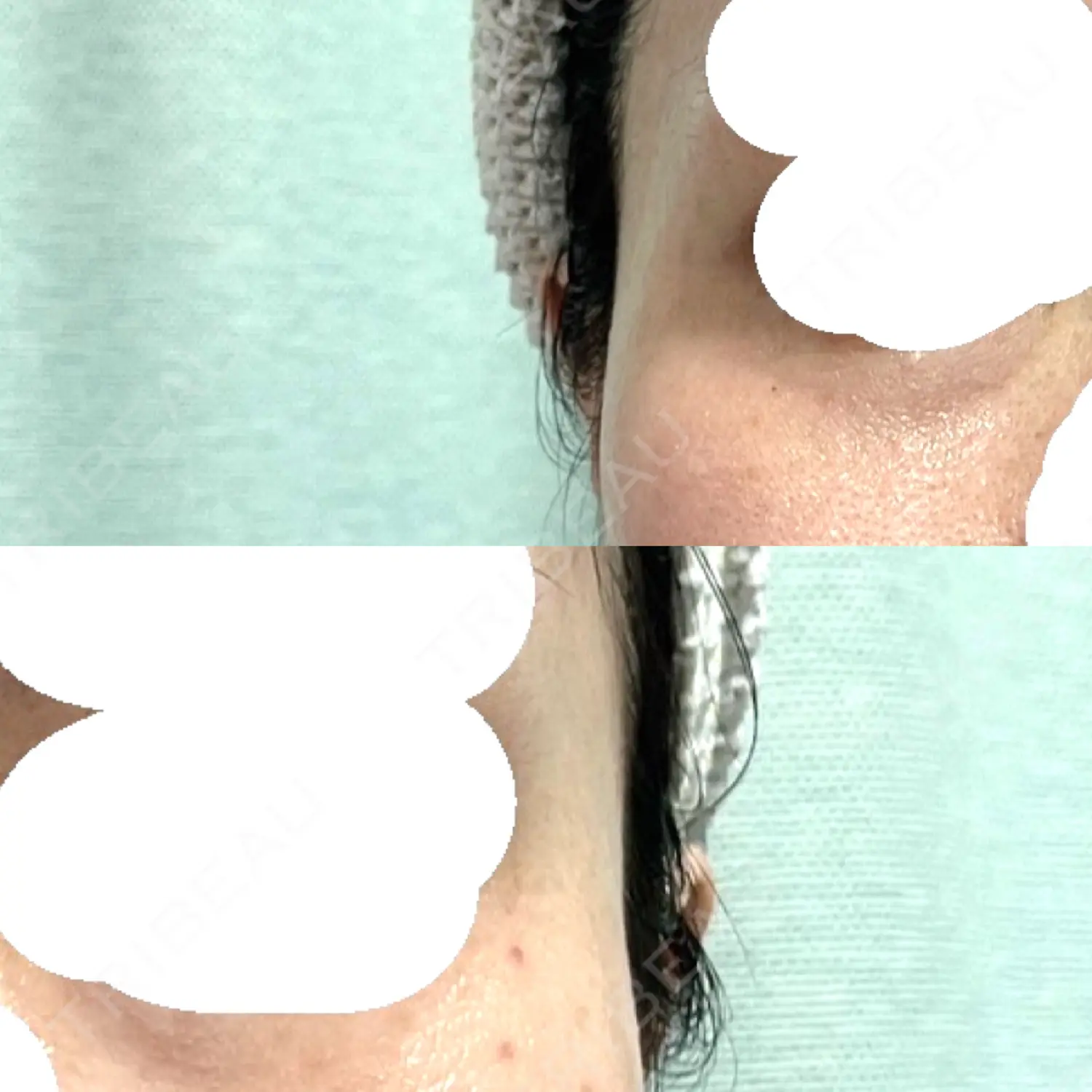 施術後の写真