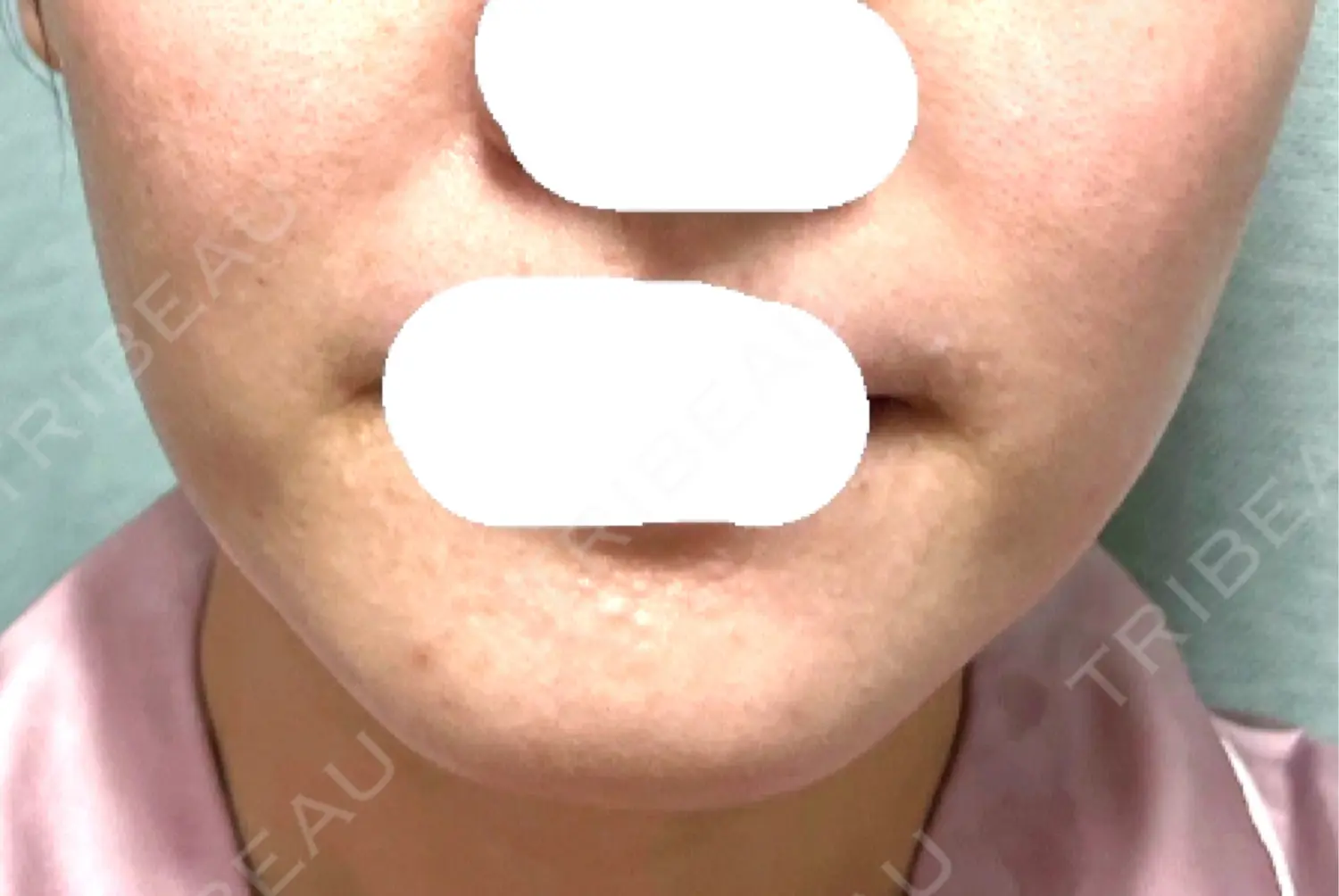 施術後の写真