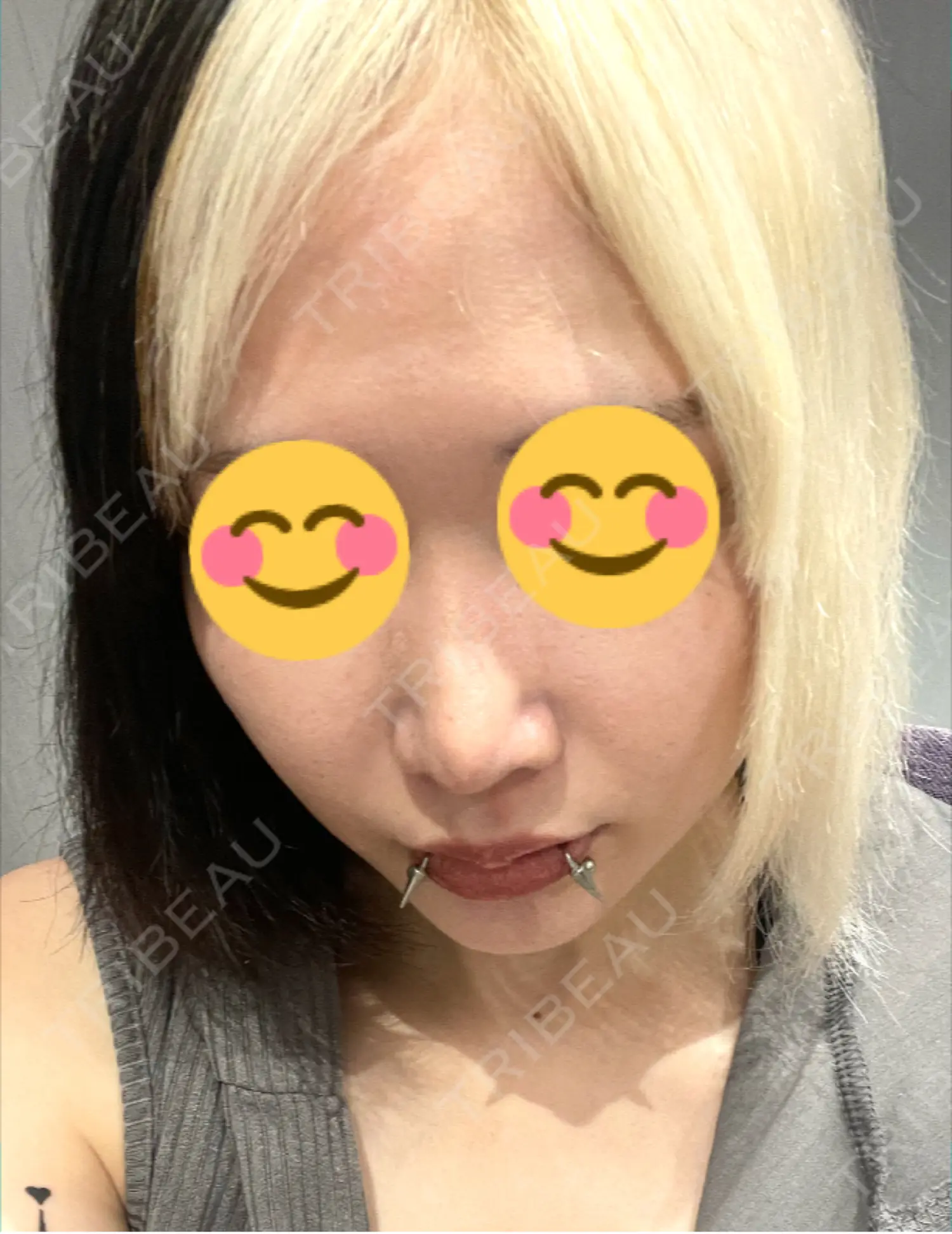 施術後の写真