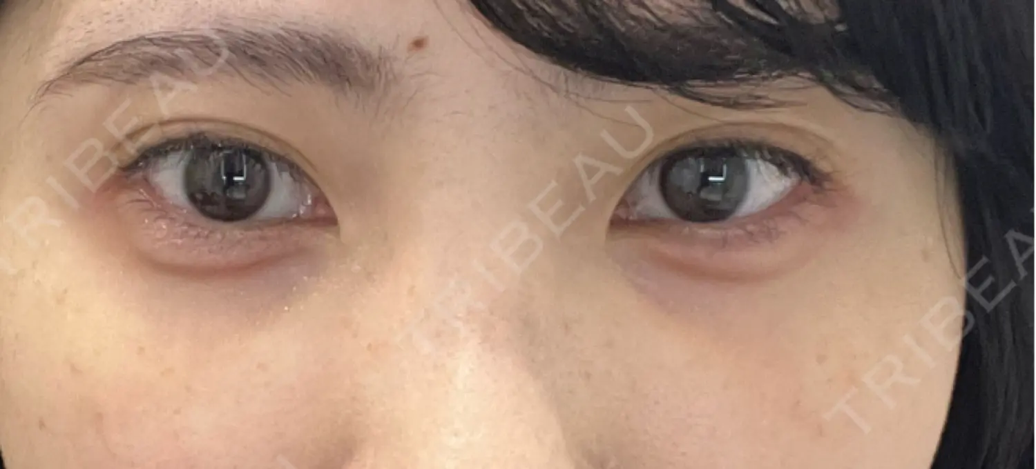 施術後の写真