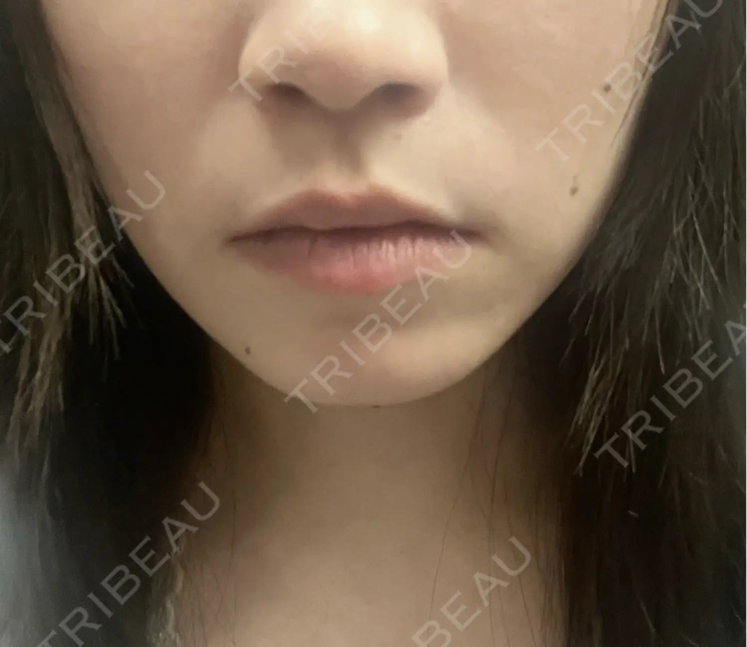 施術後の写真