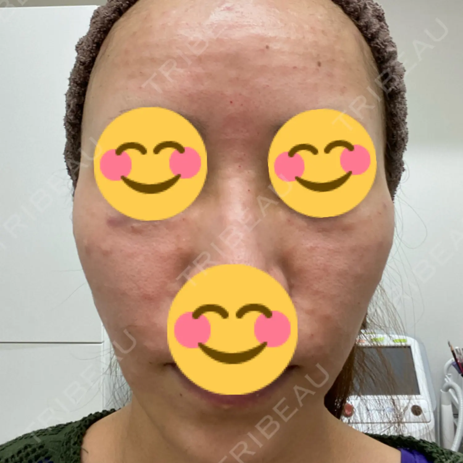 施術後の写真