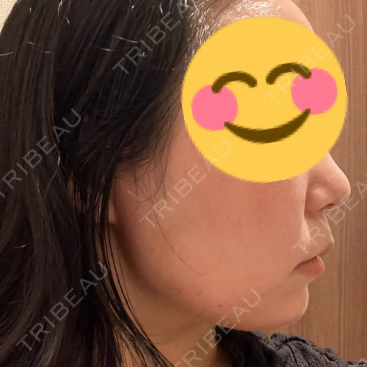 施術後の写真
