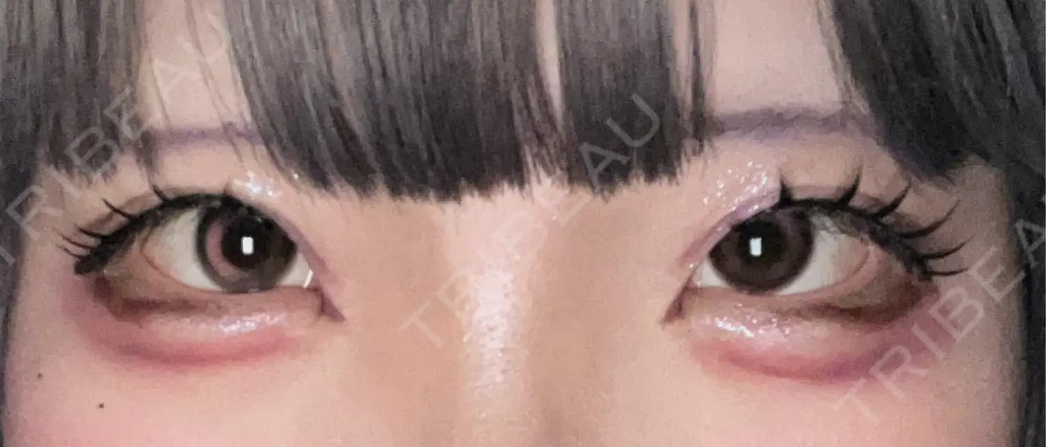 施術後の写真