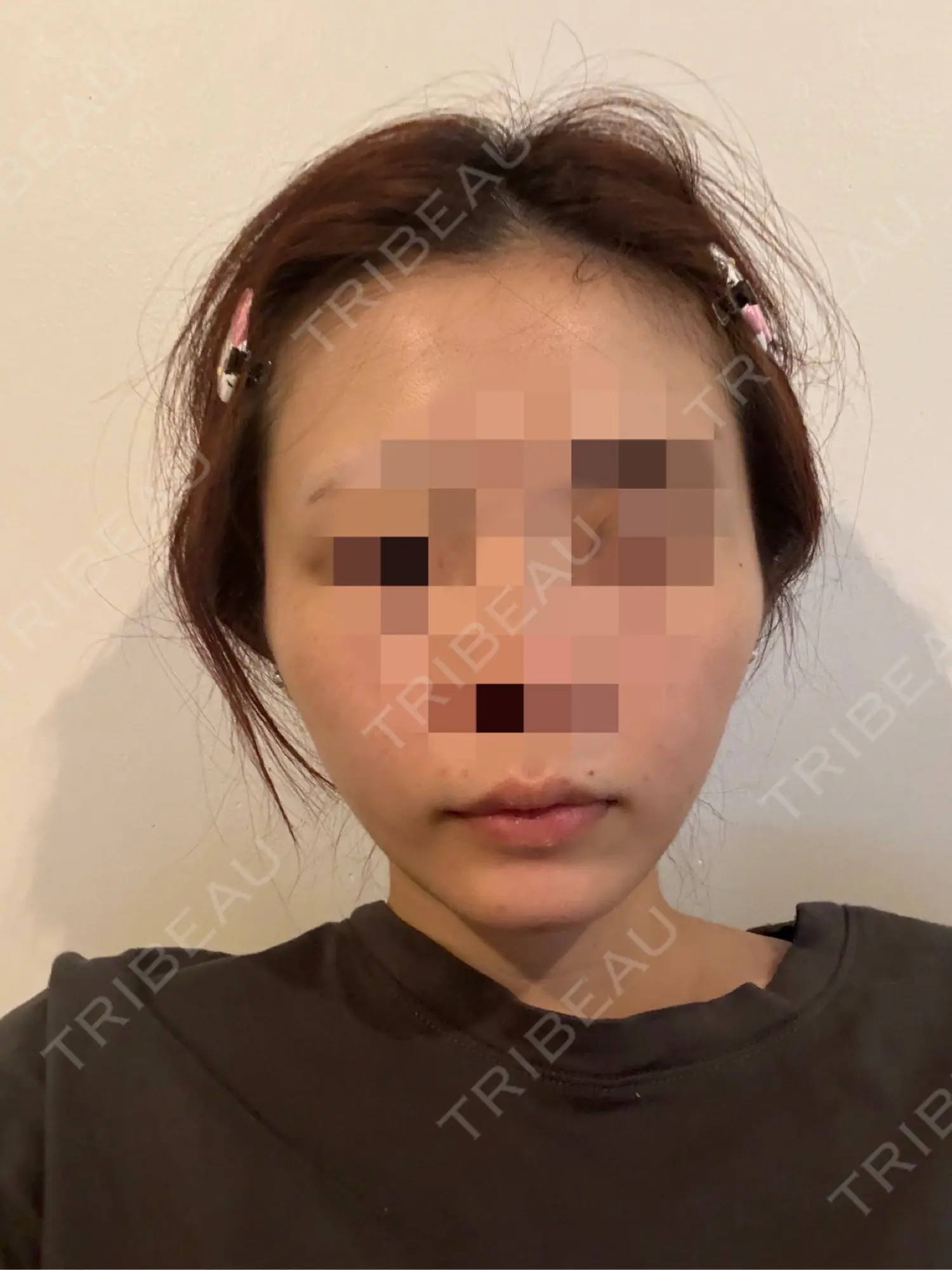 施術後の写真