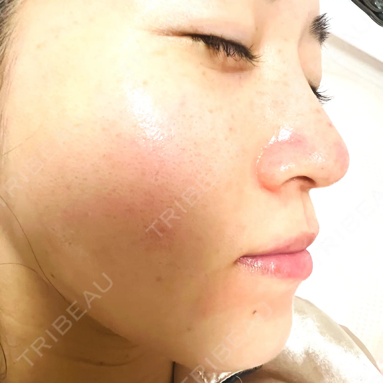 施術後の写真