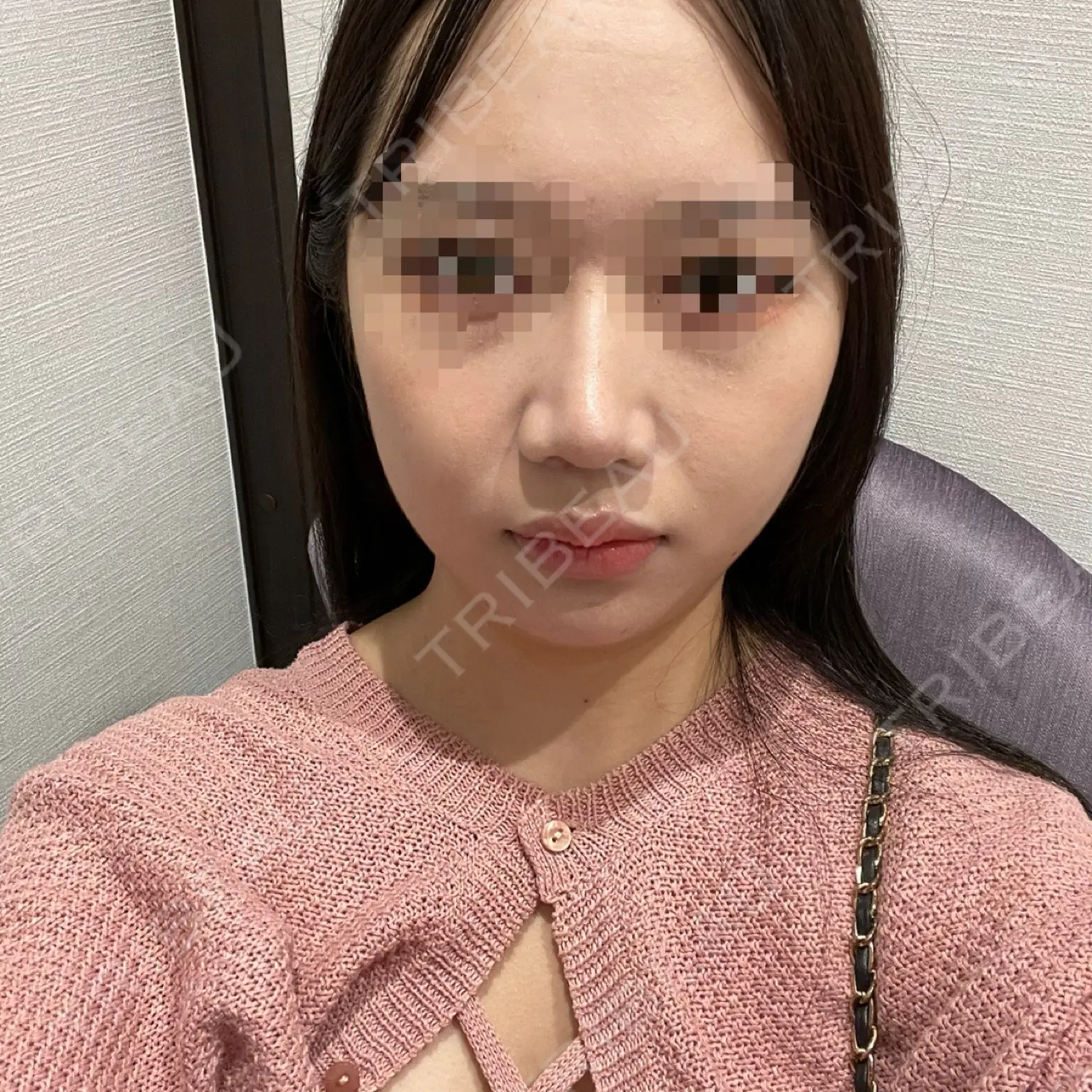 施術後の写真