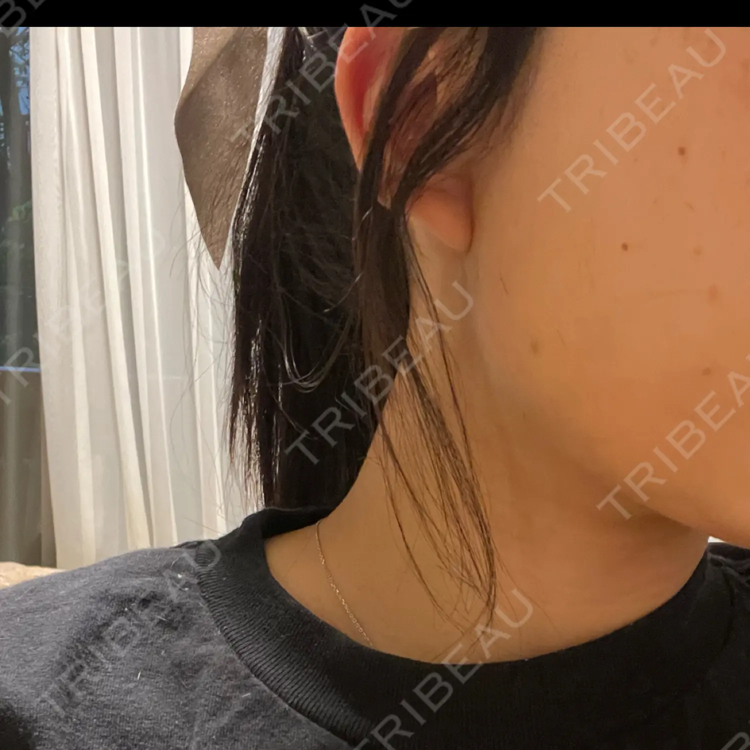 施術後の写真