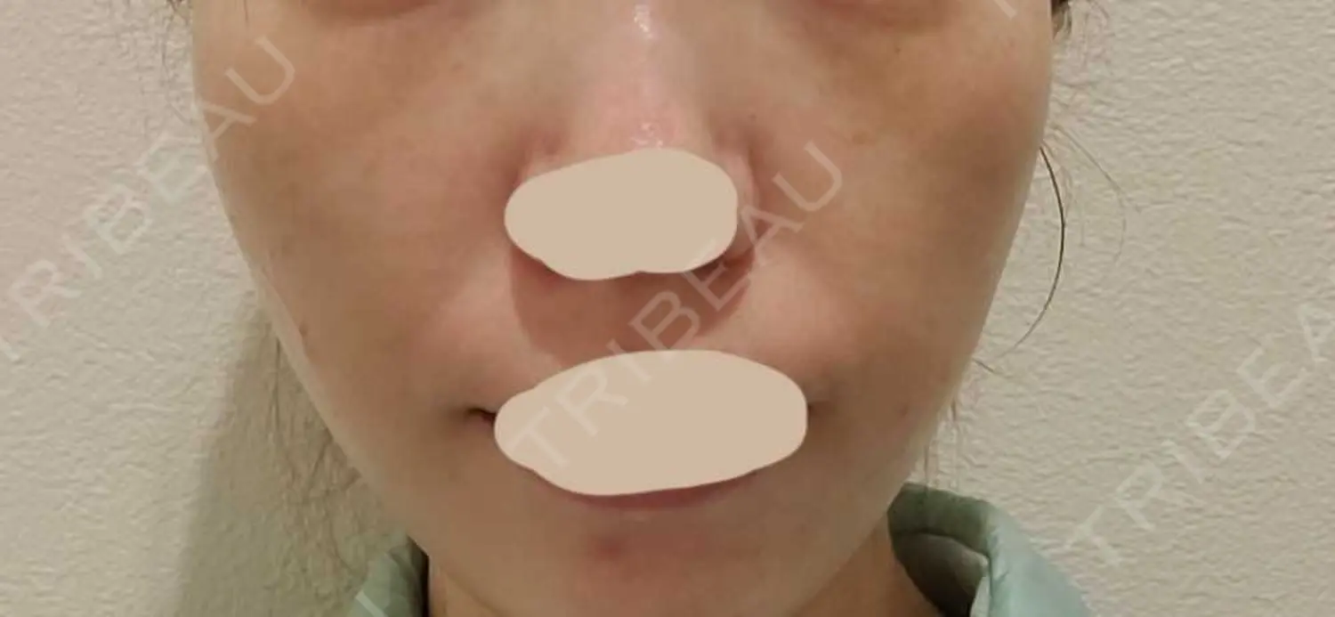 施術後の写真