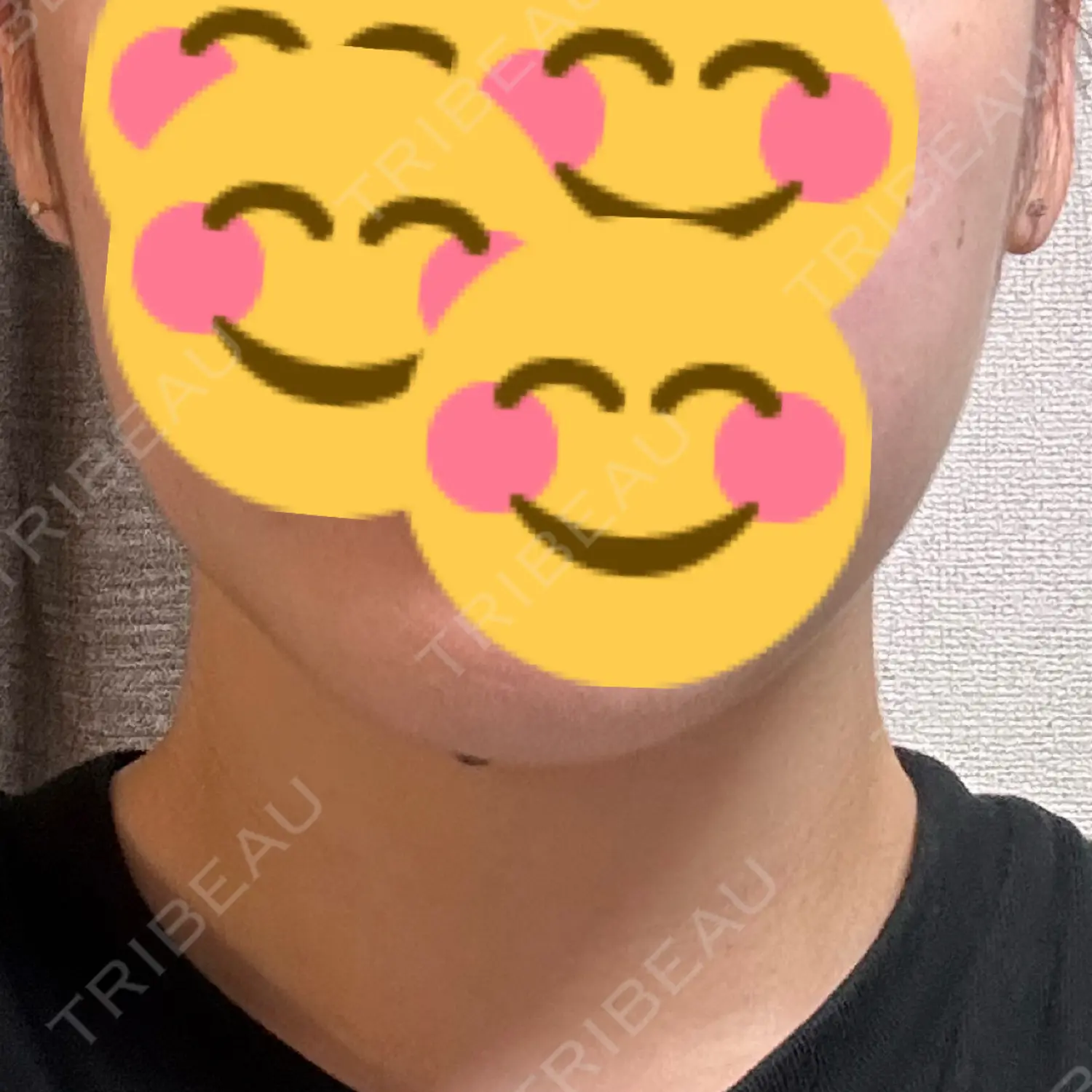 施術後の写真