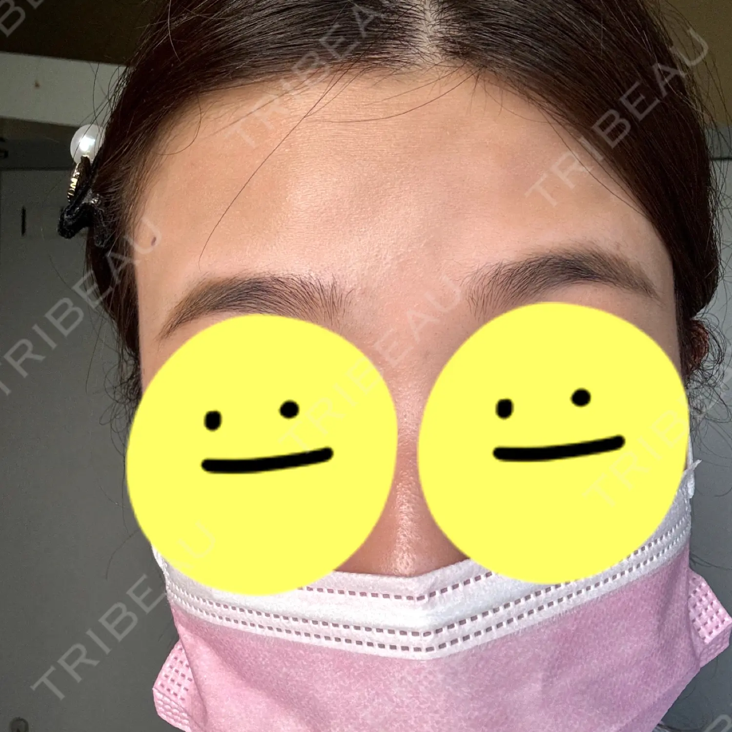 施術後の写真