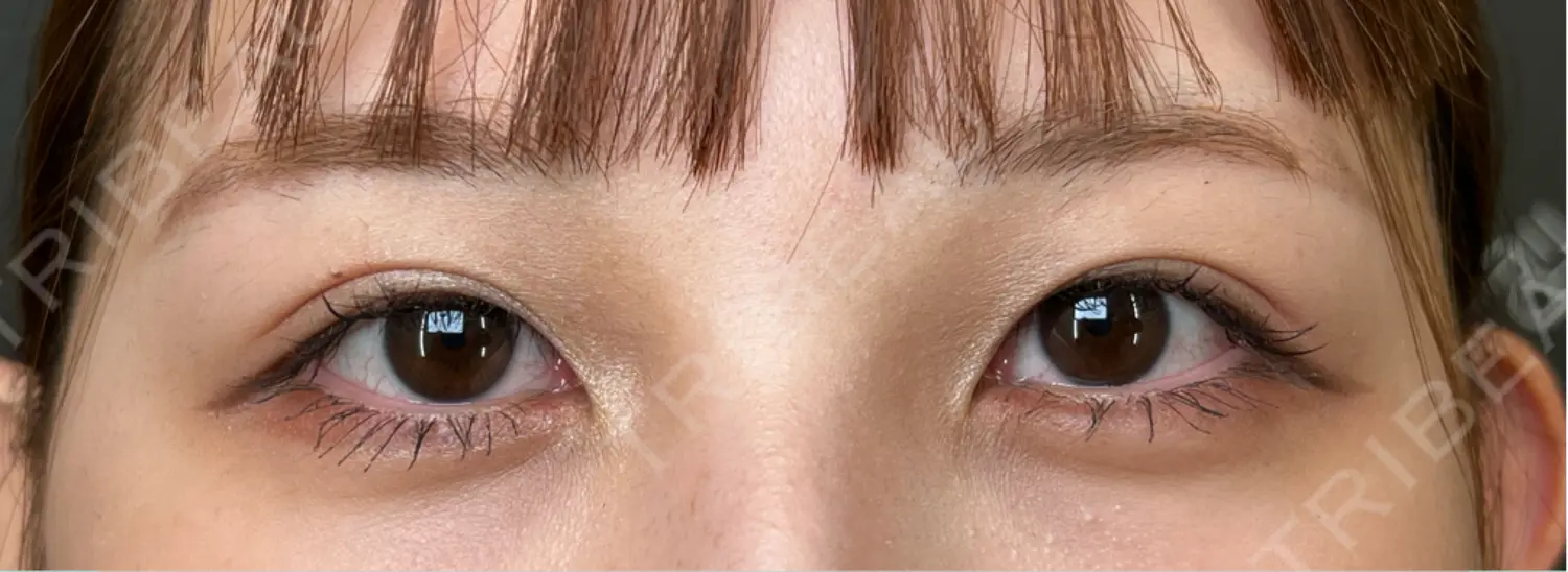 施術後の写真