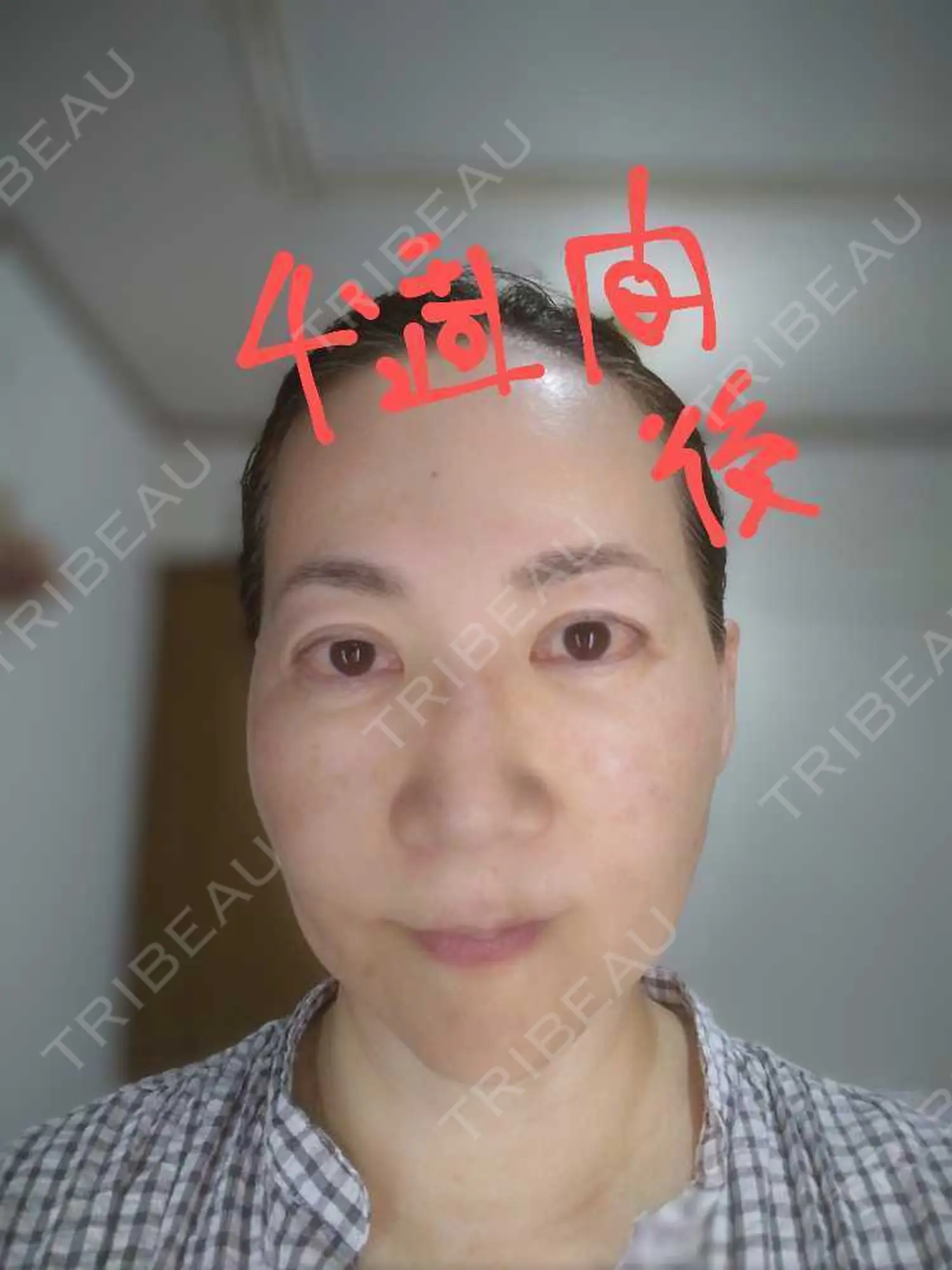 施術後の写真
