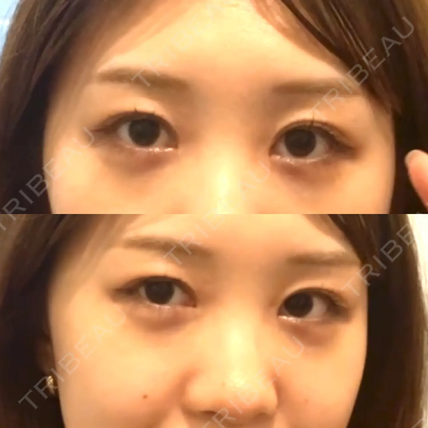 施術後の写真