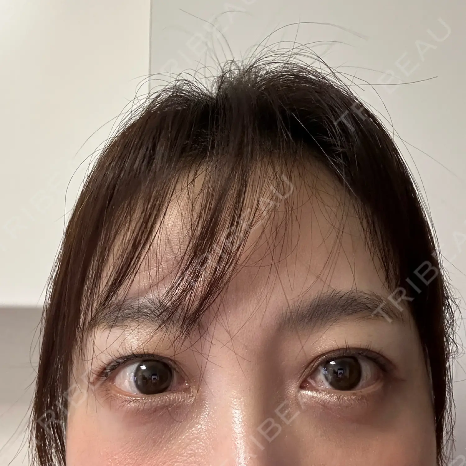 施術後の写真