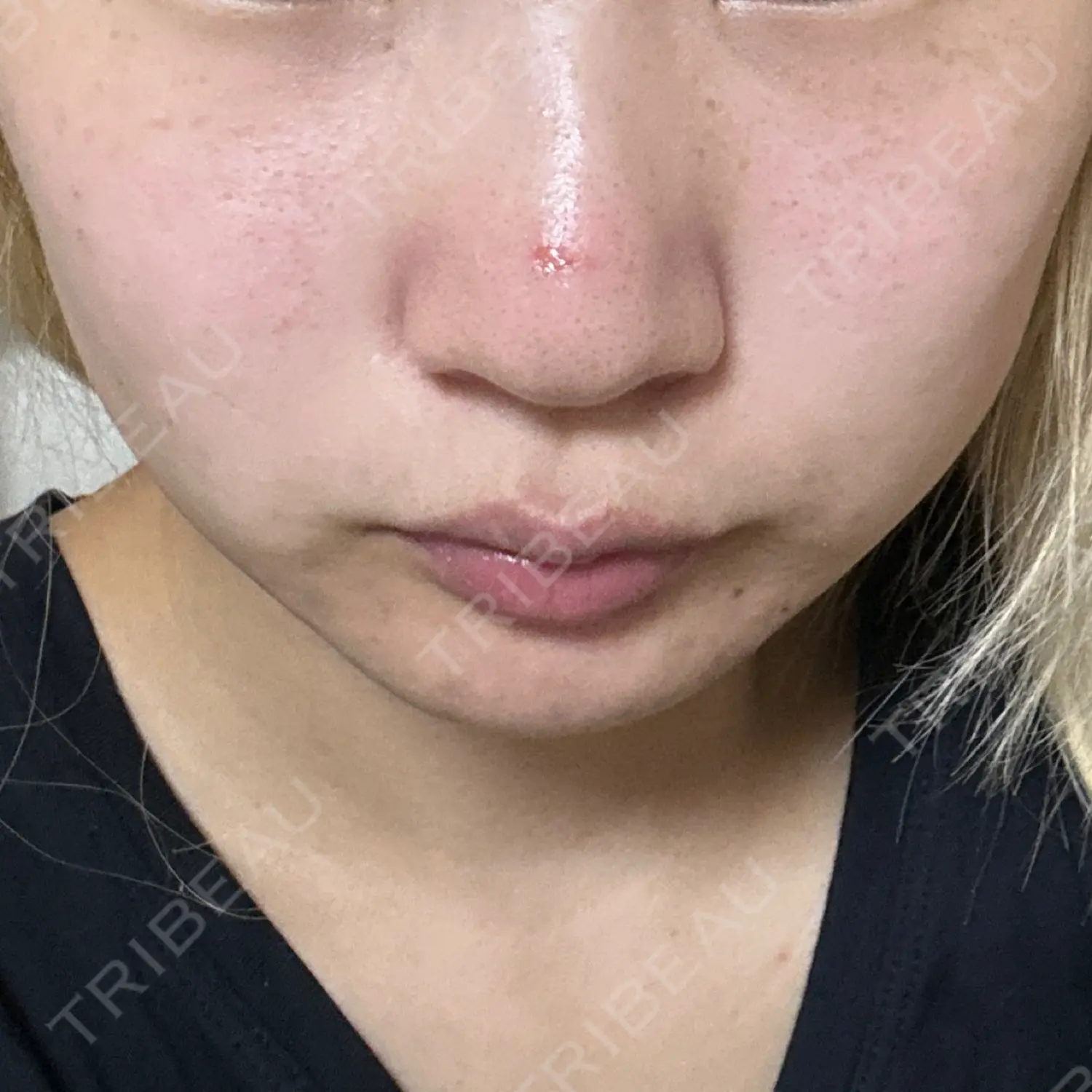 施術後の写真