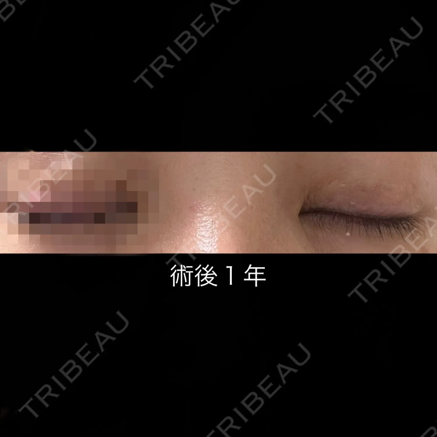 施術後の写真