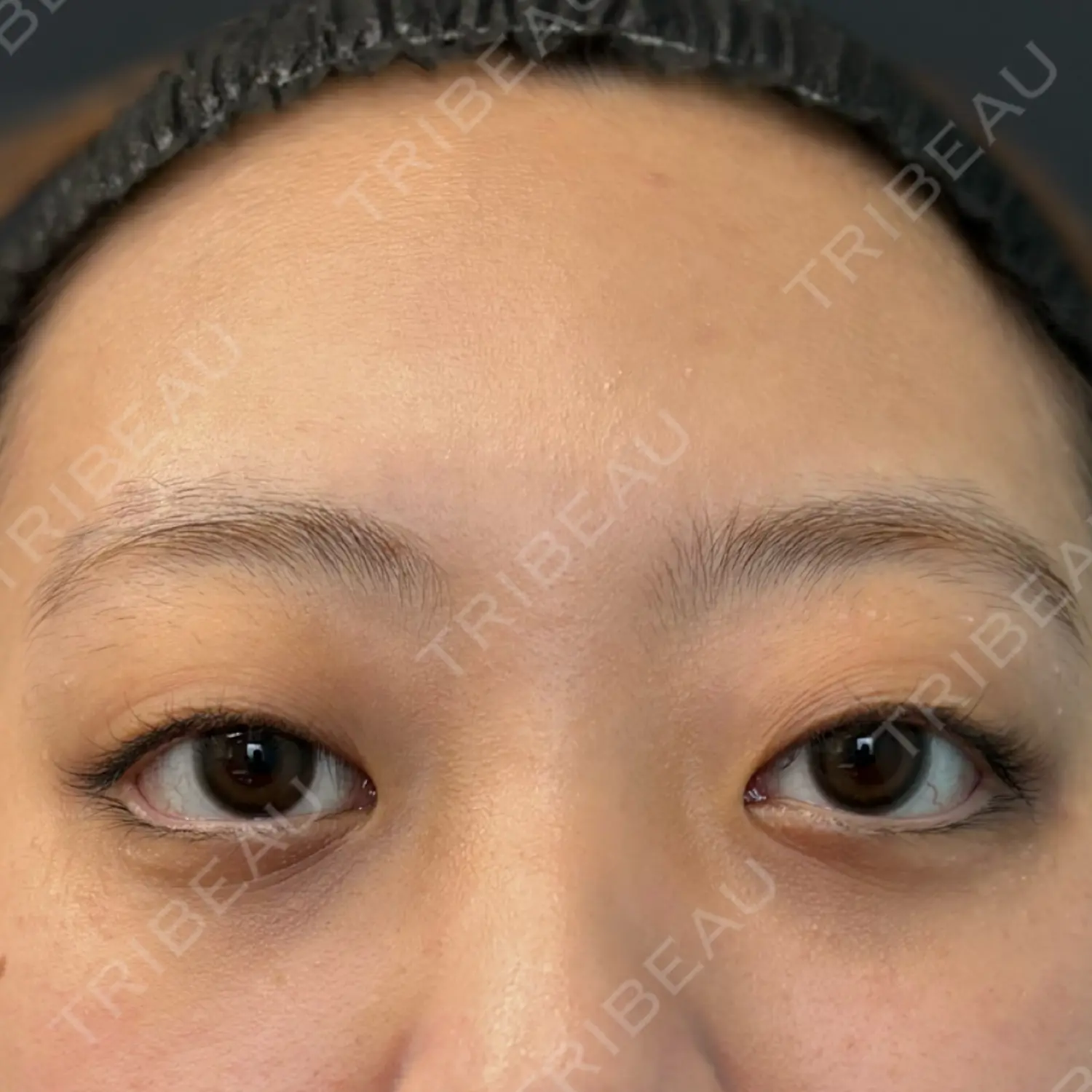施術後の写真