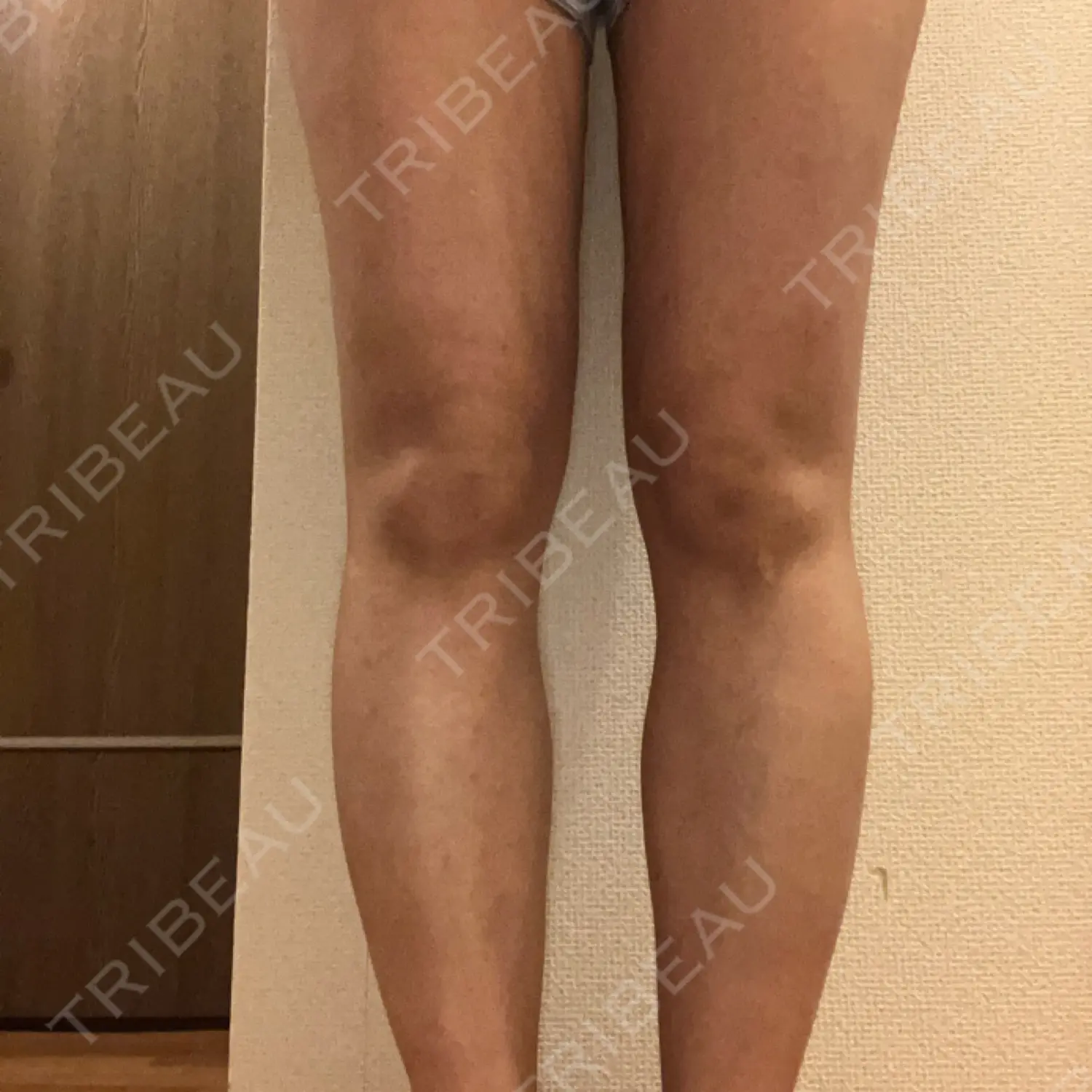 施術後の写真