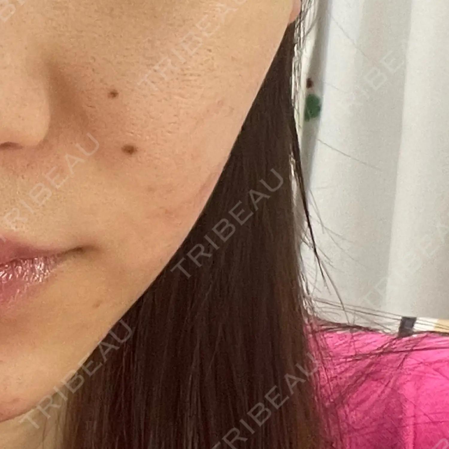 施術後の写真