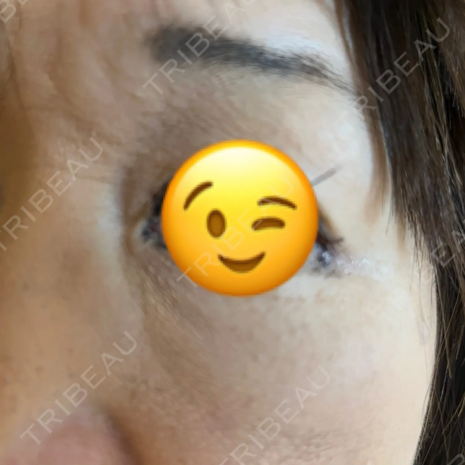 施術後の写真