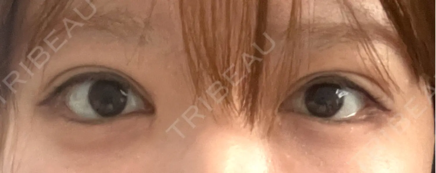 施術後の写真