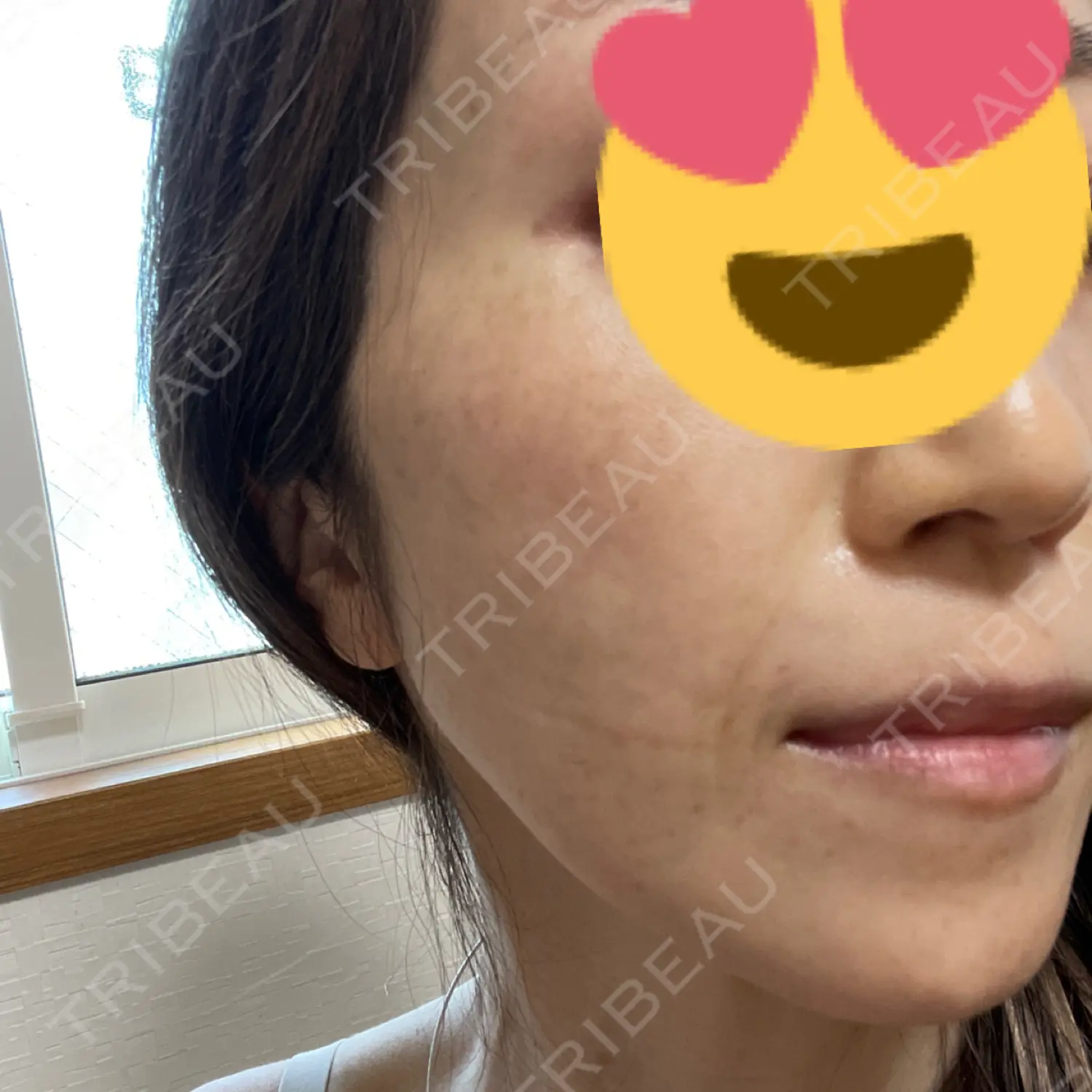 施術後の写真