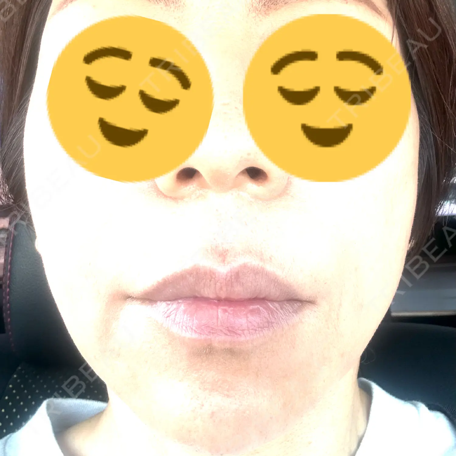 施術後の写真
