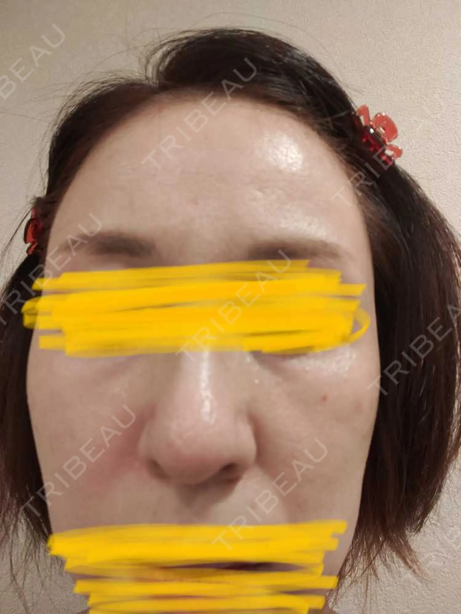 施術後の写真