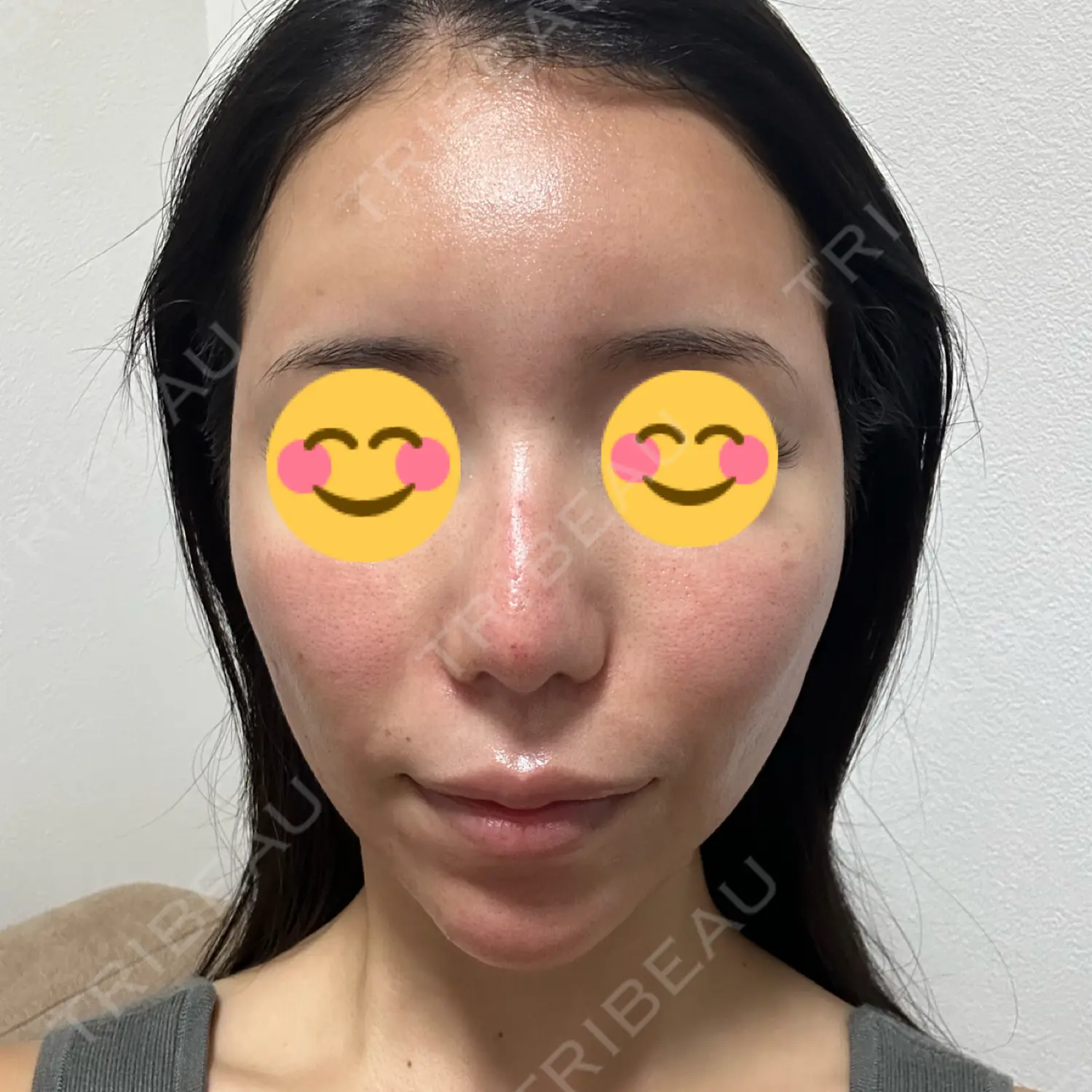 施術後の写真
