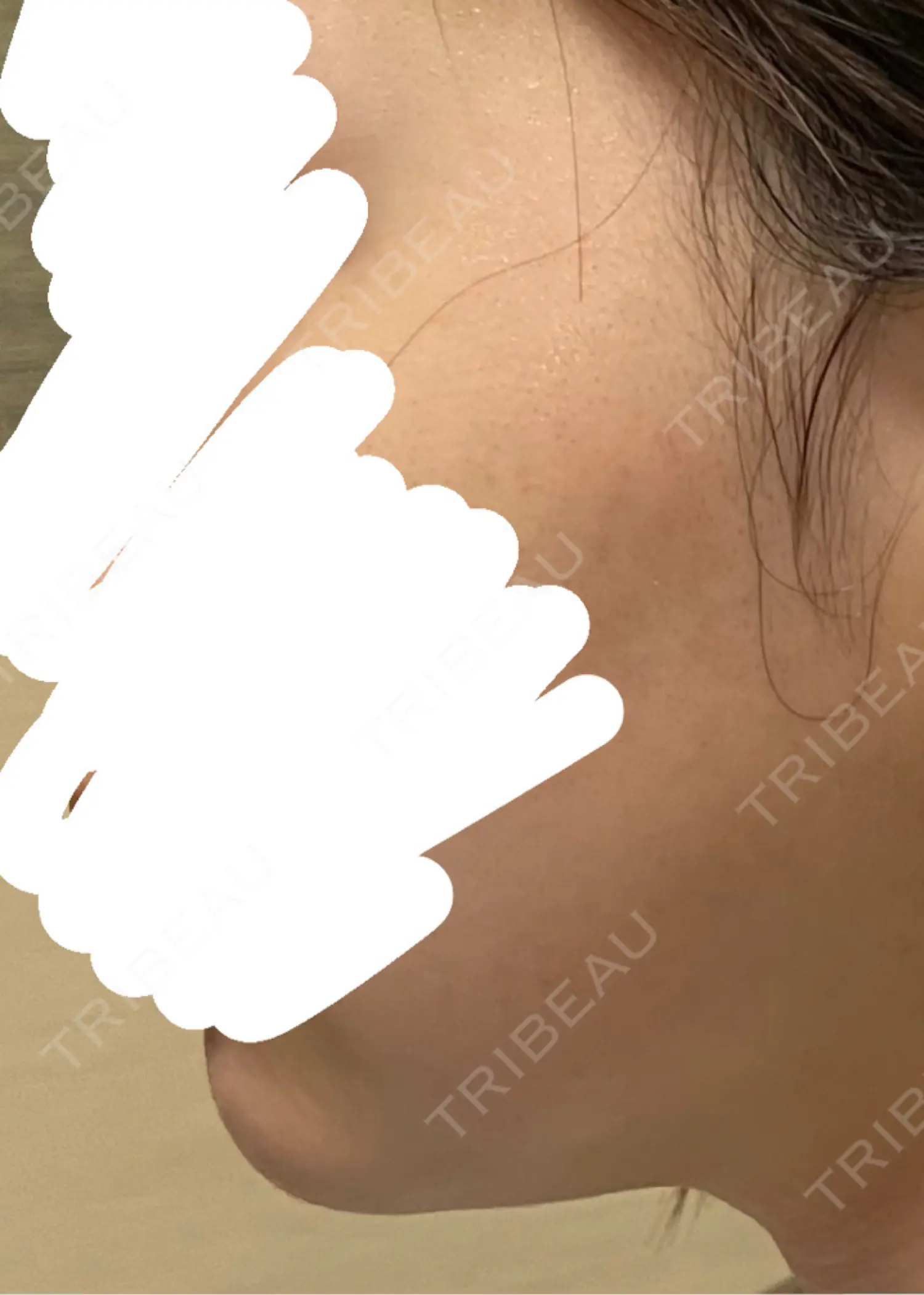 施術後の写真