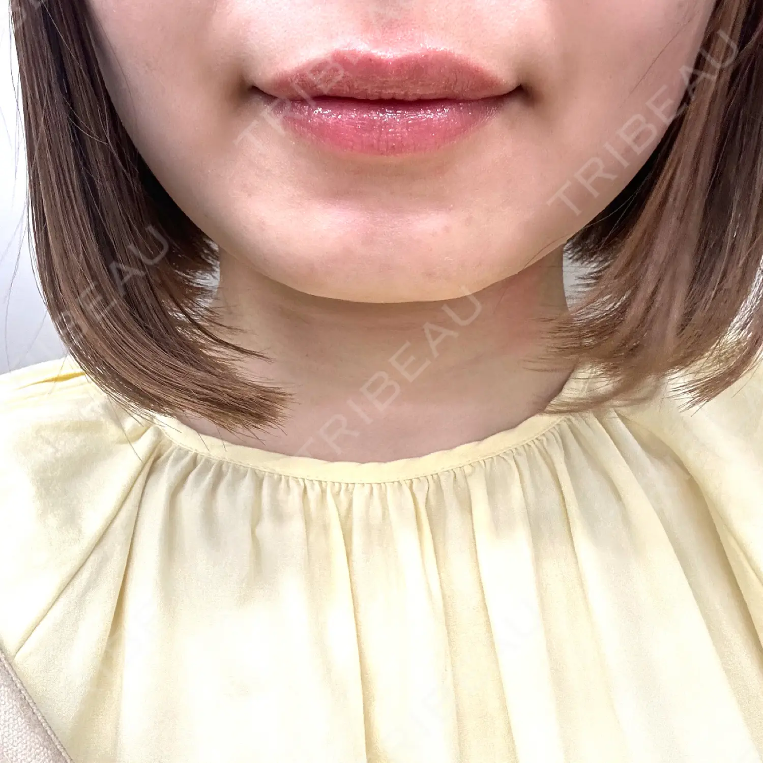 施術後の写真