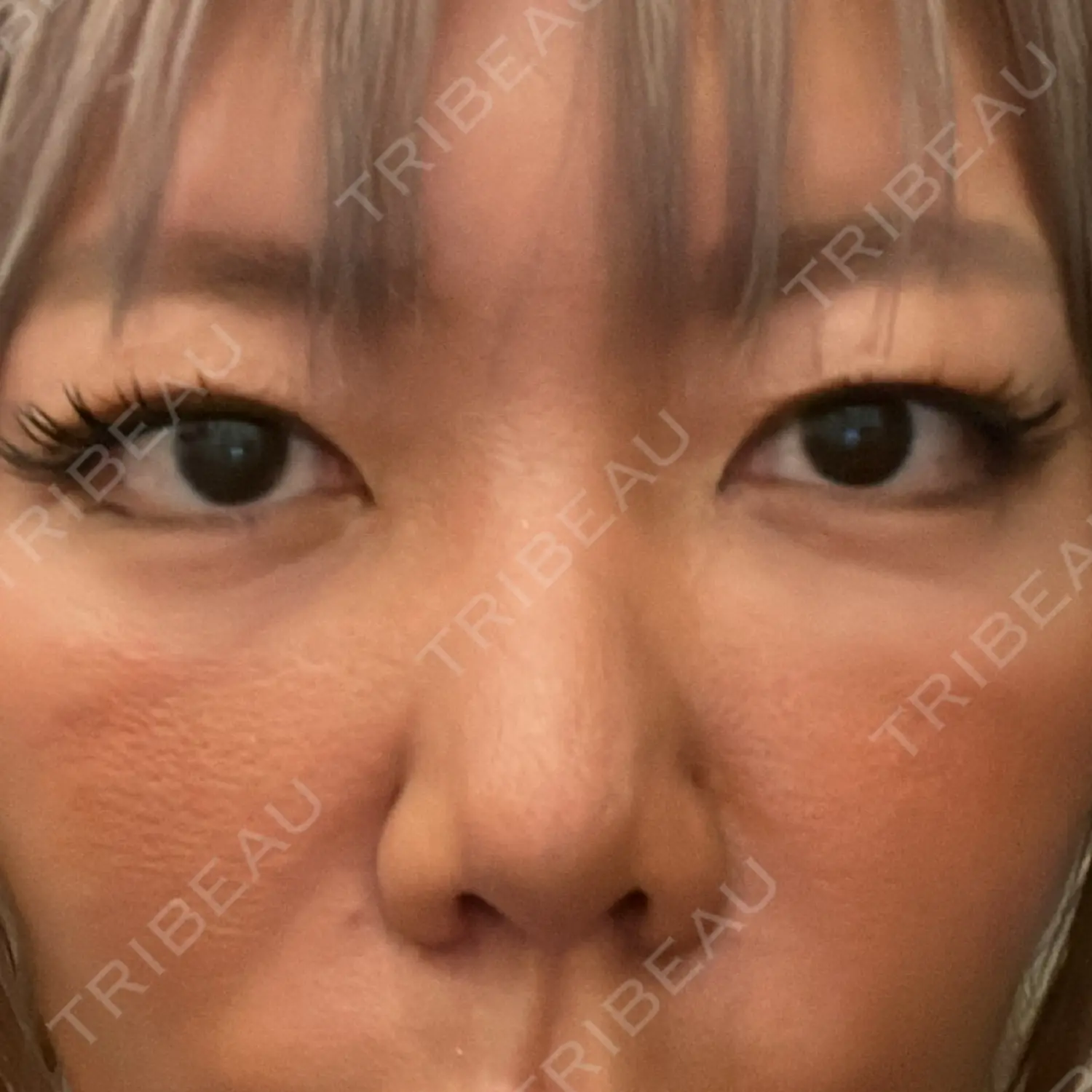 施術後の写真
