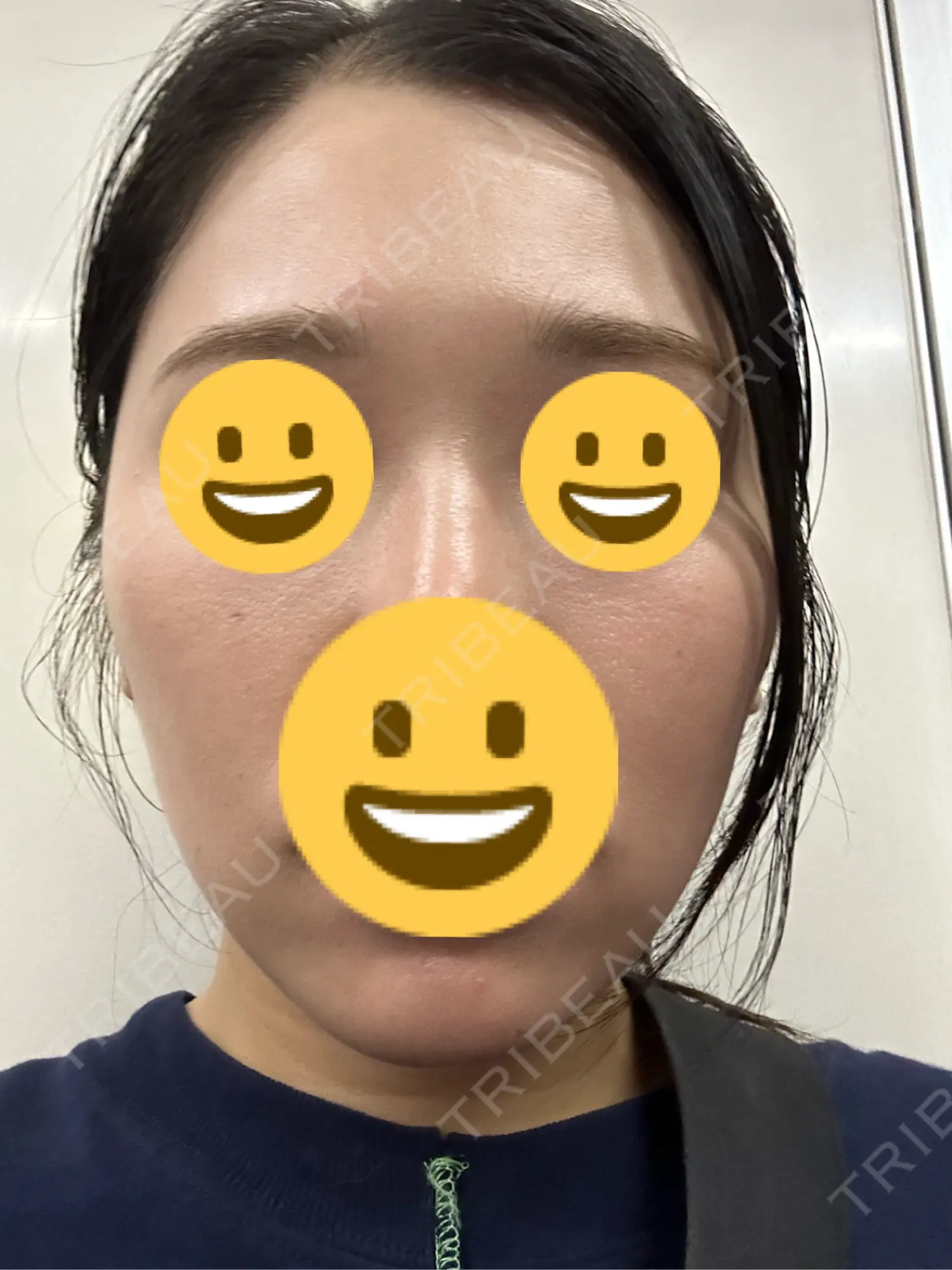 施術後の写真