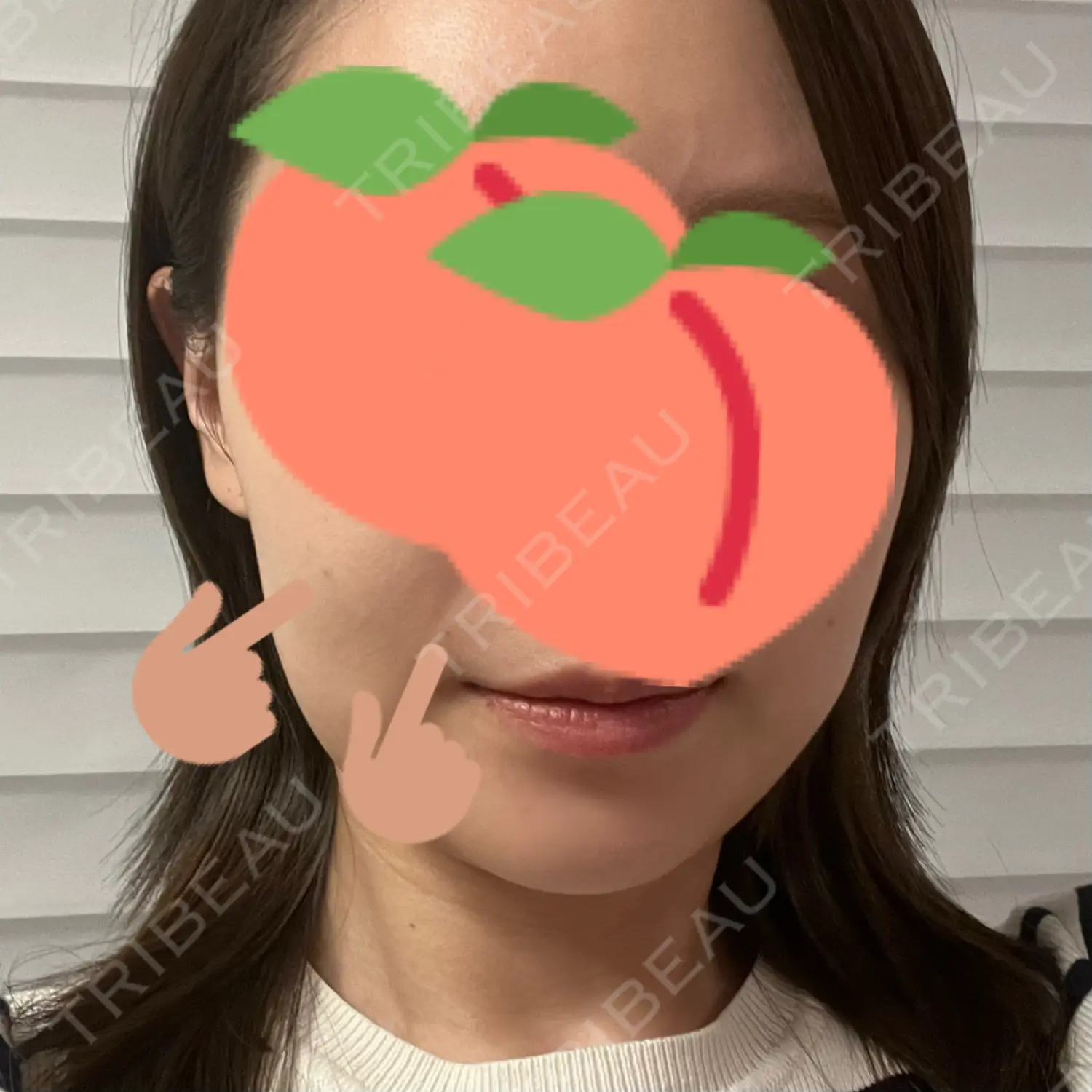 施術後の写真