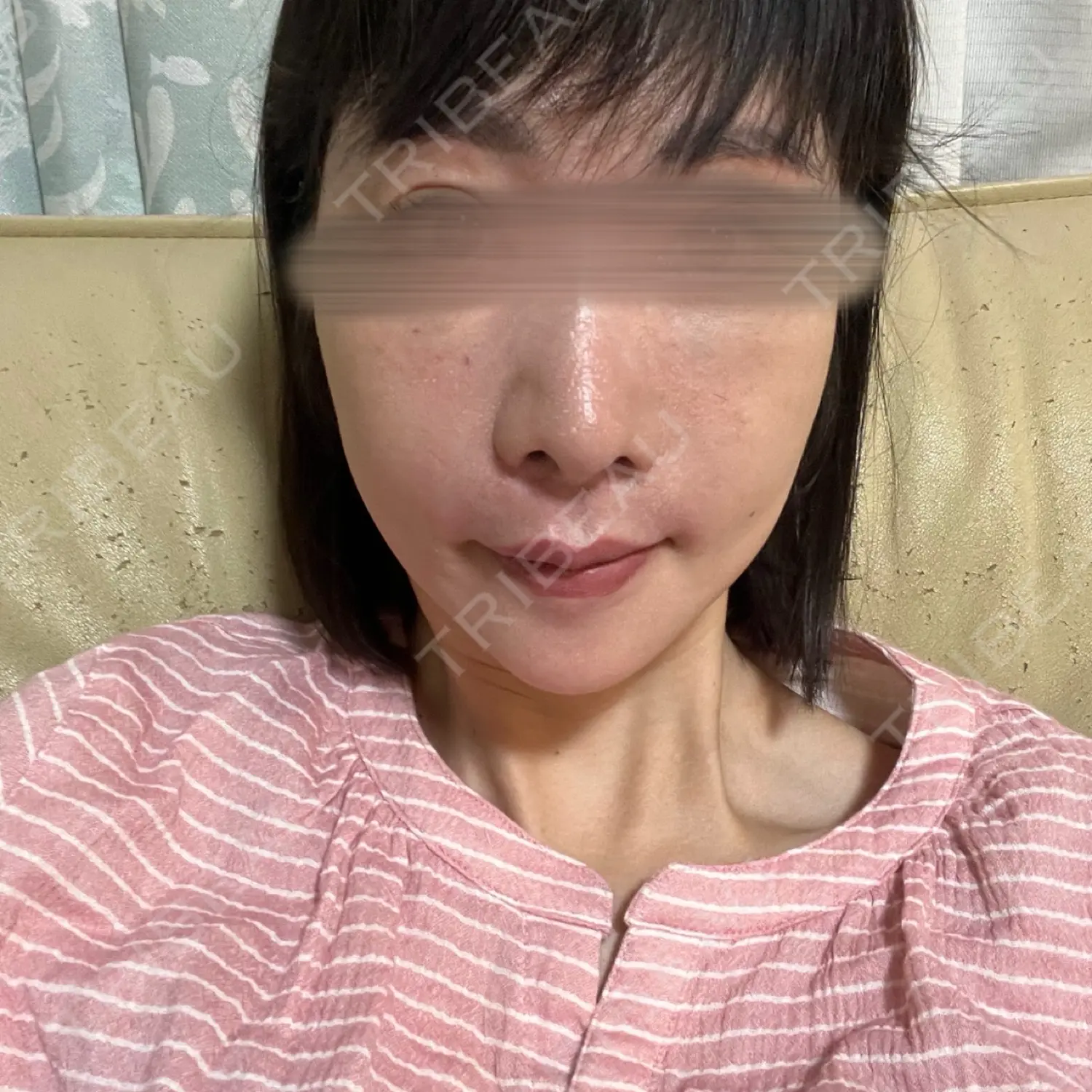 施術後の写真