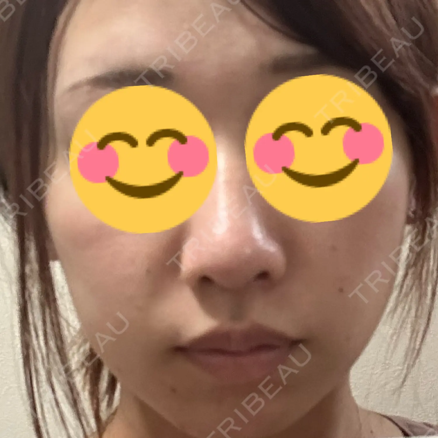施術後の写真